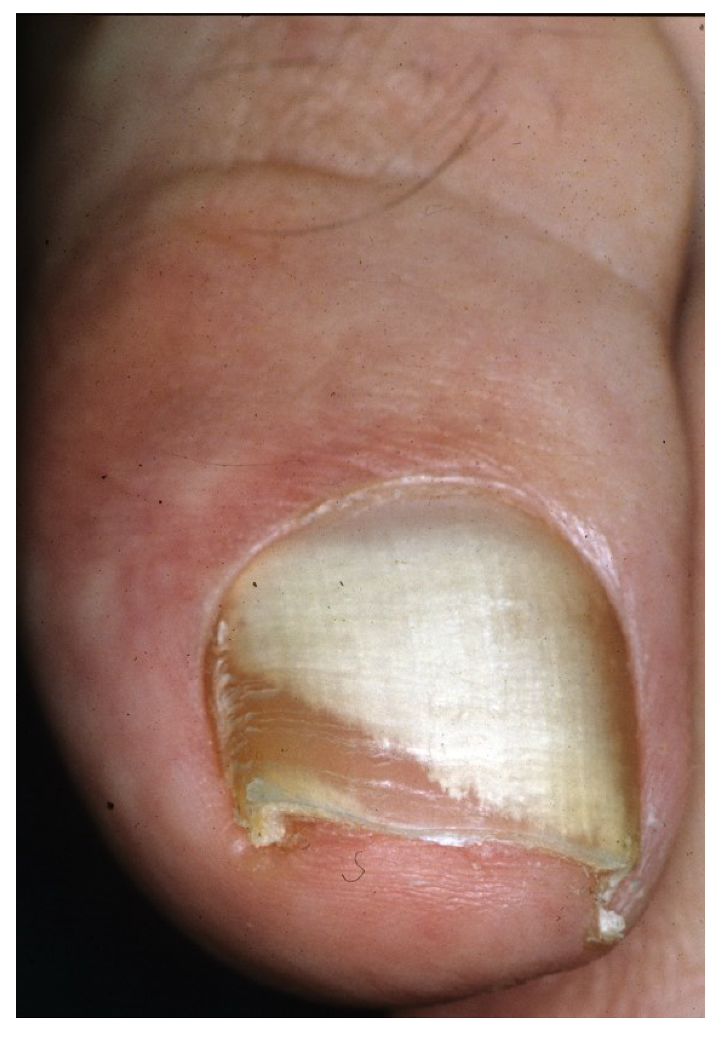 Transverse, brown-greyish hyperpigmentation on the proximal half of the...  | Download Scientific Diagram