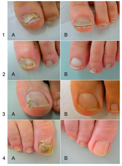 Fingernail disease hi-res stock photography and images - Page 2 - Alamy