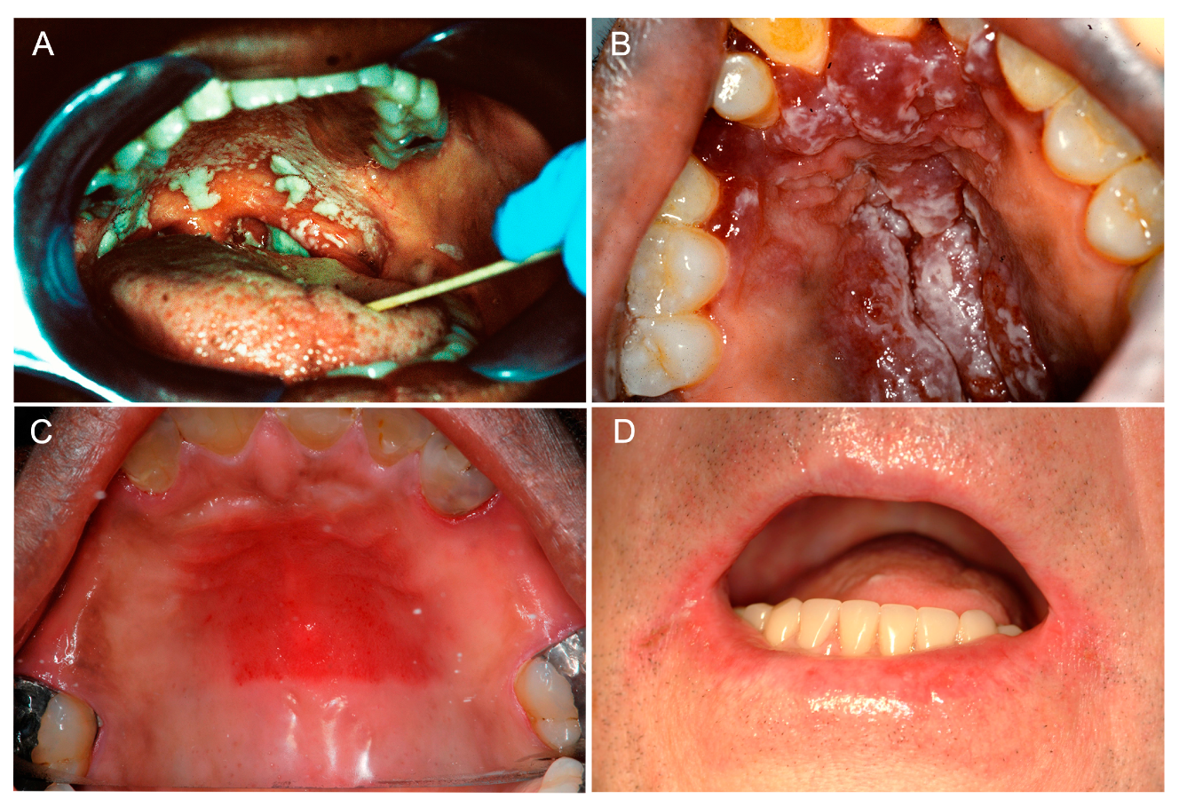 Severe online oral thrush