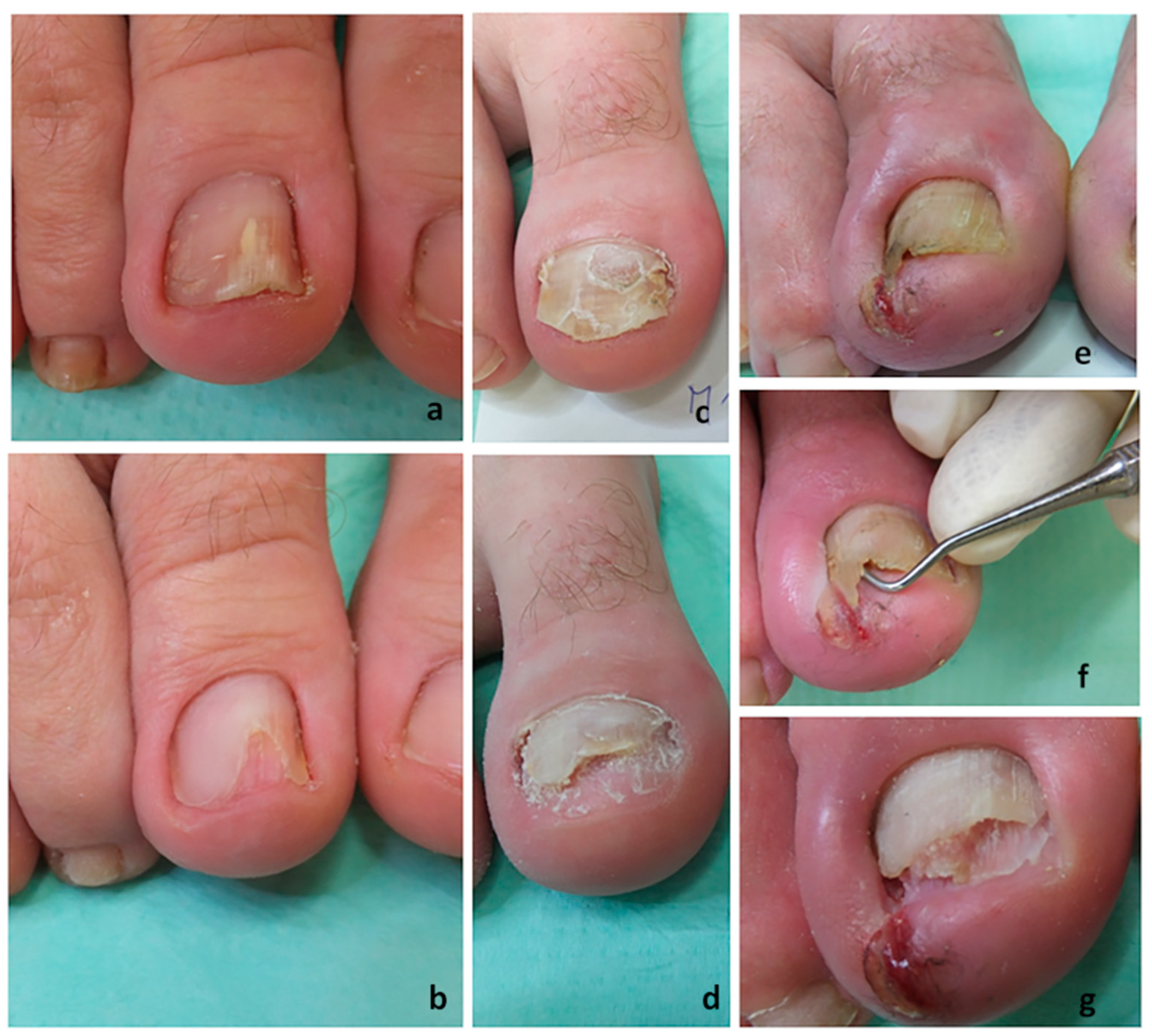 Superficial fungal diseases of the hair, skin, and nails (Chapter 26) -  Clinical Infectious Disease