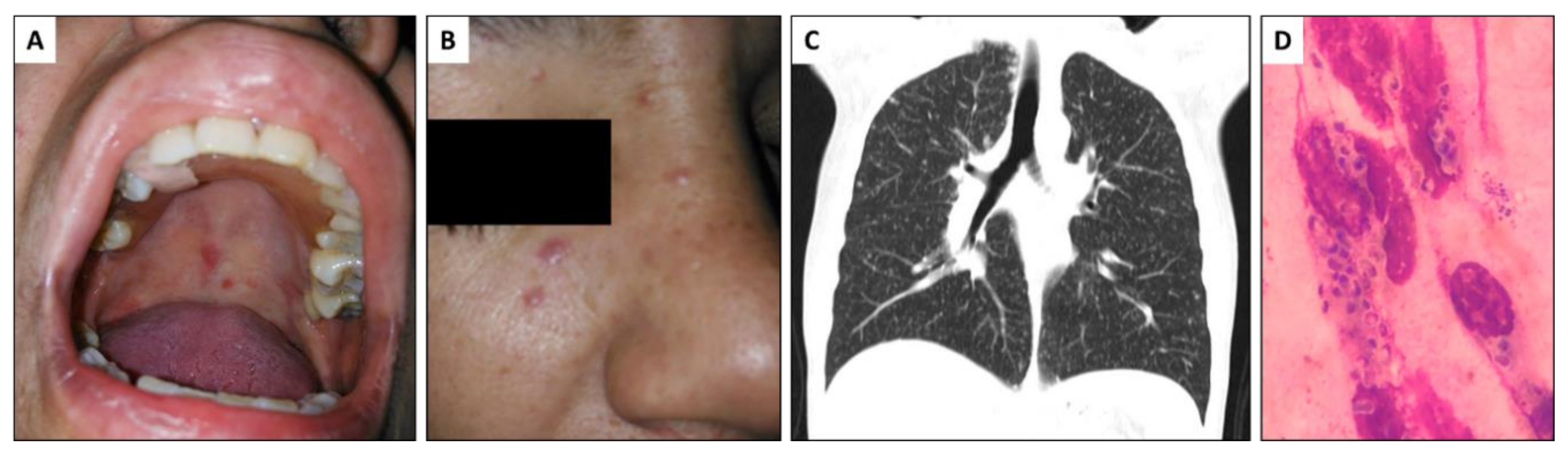 JoF | Free Full-Text | Coronavirus Disease 2019 (COVID-19) In A.