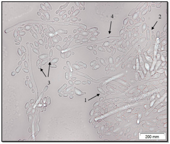 Candida parapsilosis as a Causative Agent of Onychomycosis in Patient with Cirrhosis of the Liver