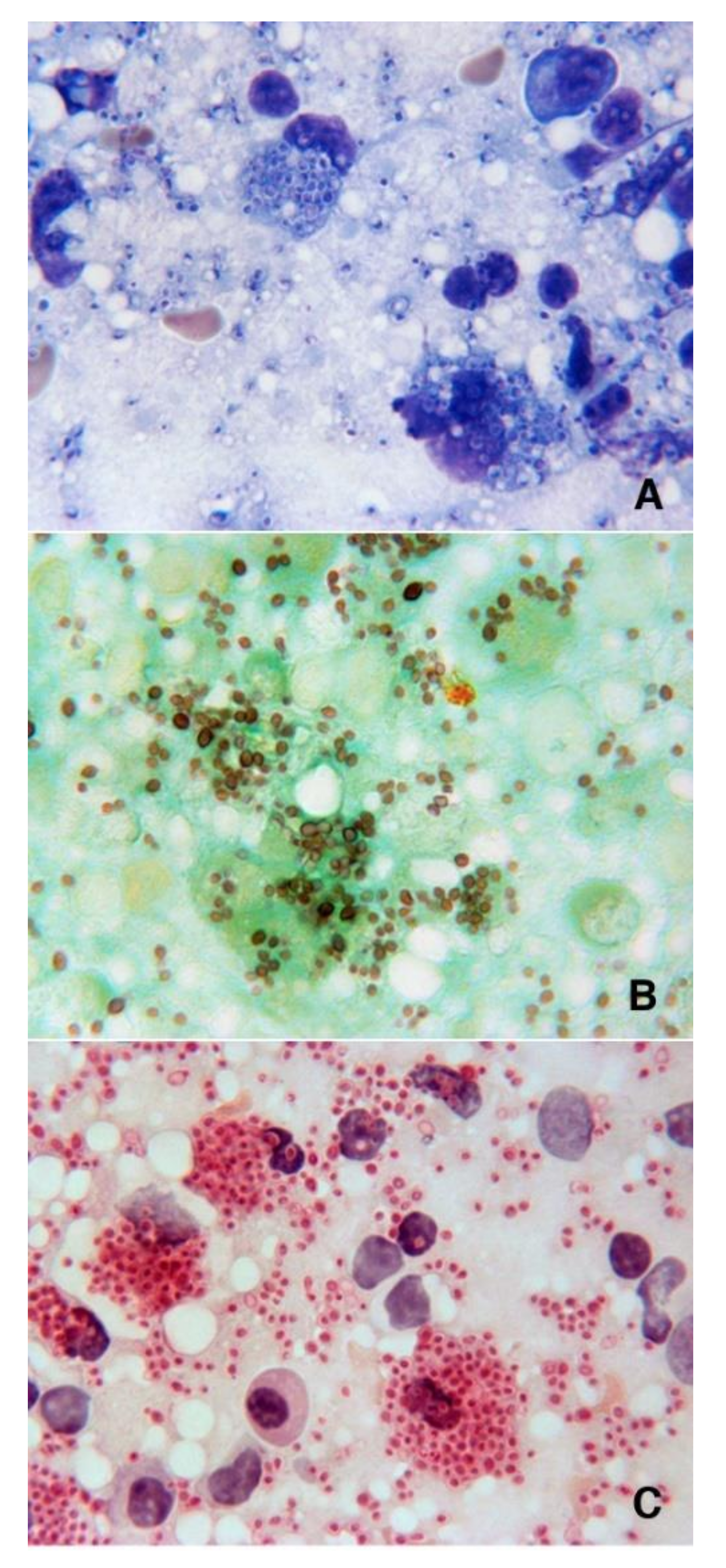 Jof Free Full Text Histoplasmosis Diagnosed In Europe And Israel A Case Report And Systematic Review Of The Literature From 05 To Html