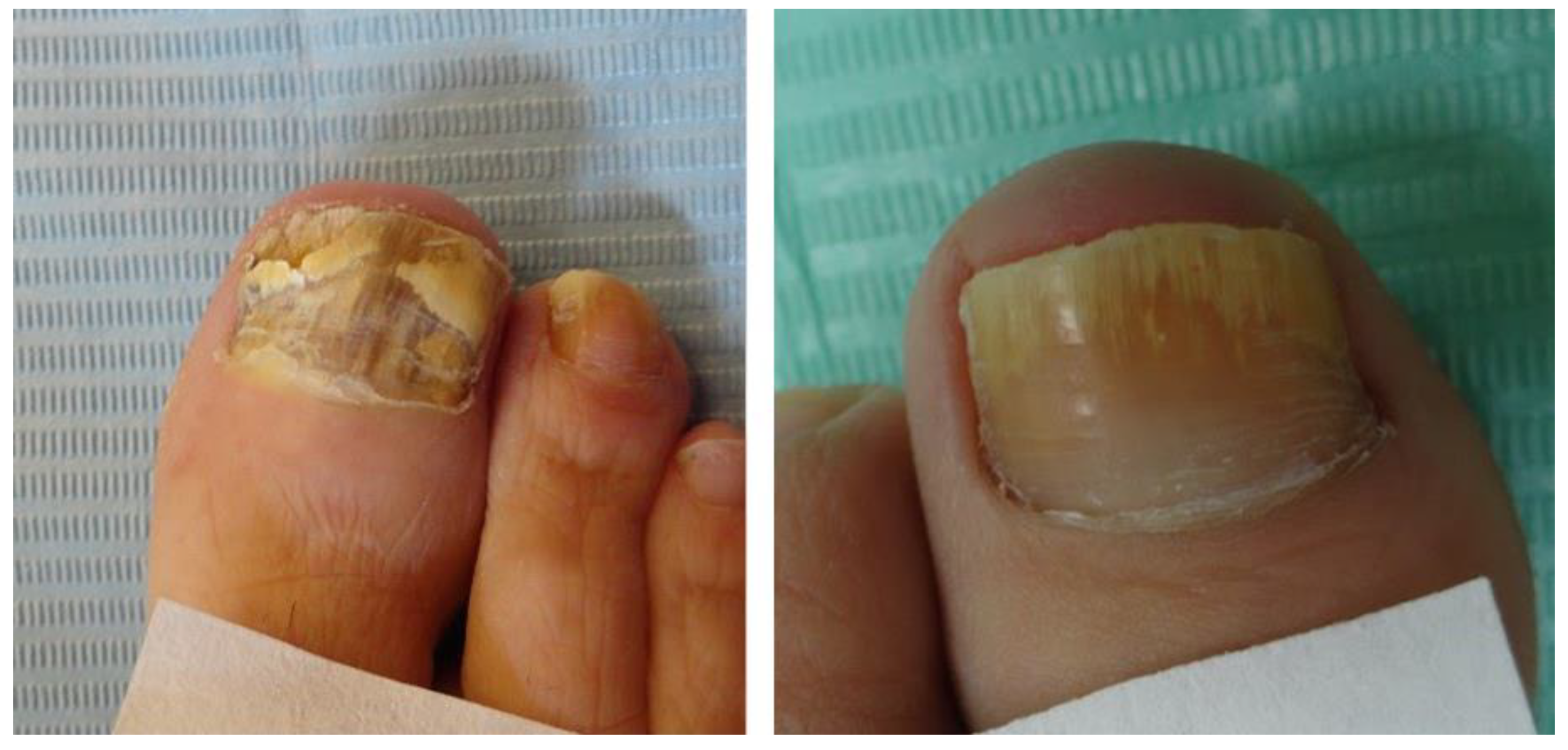 széklet parazita vizsgálat enterobiasis medscape
