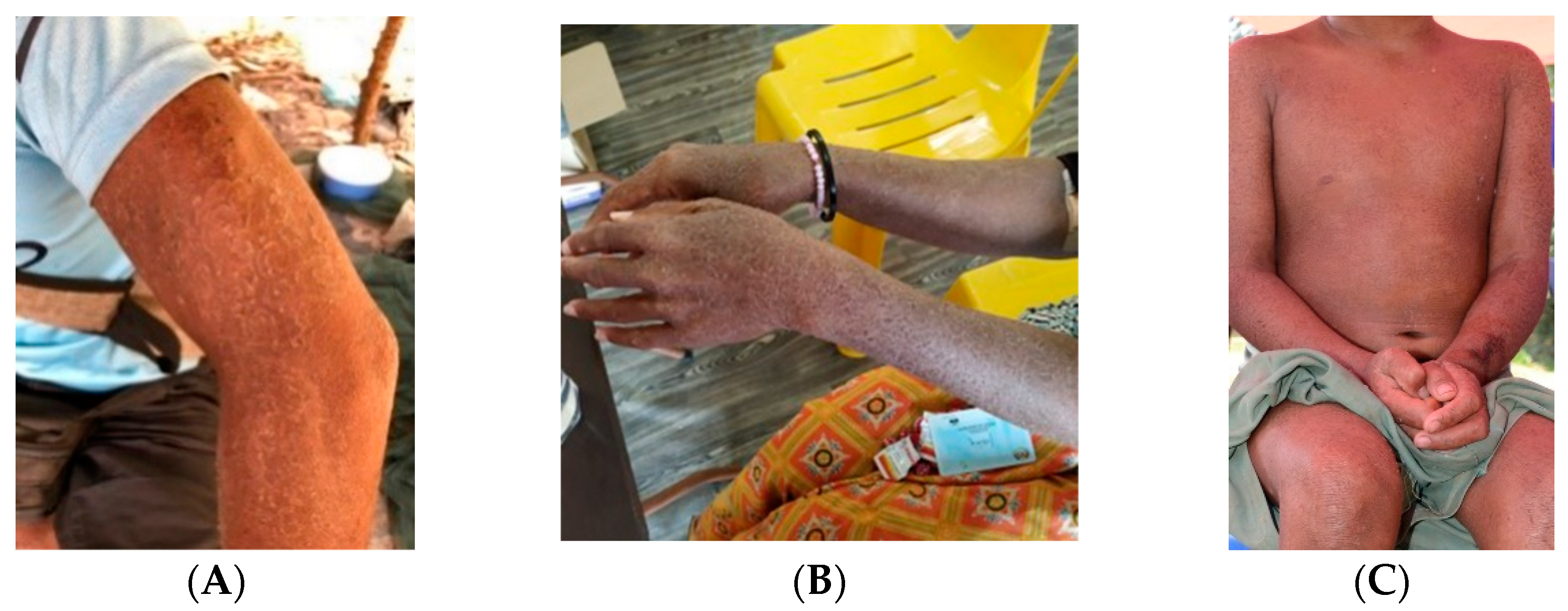 Tinea capitis in the pediatric population: A study from North India -  Indian Journal of Dermatology, Venereology and Leprology