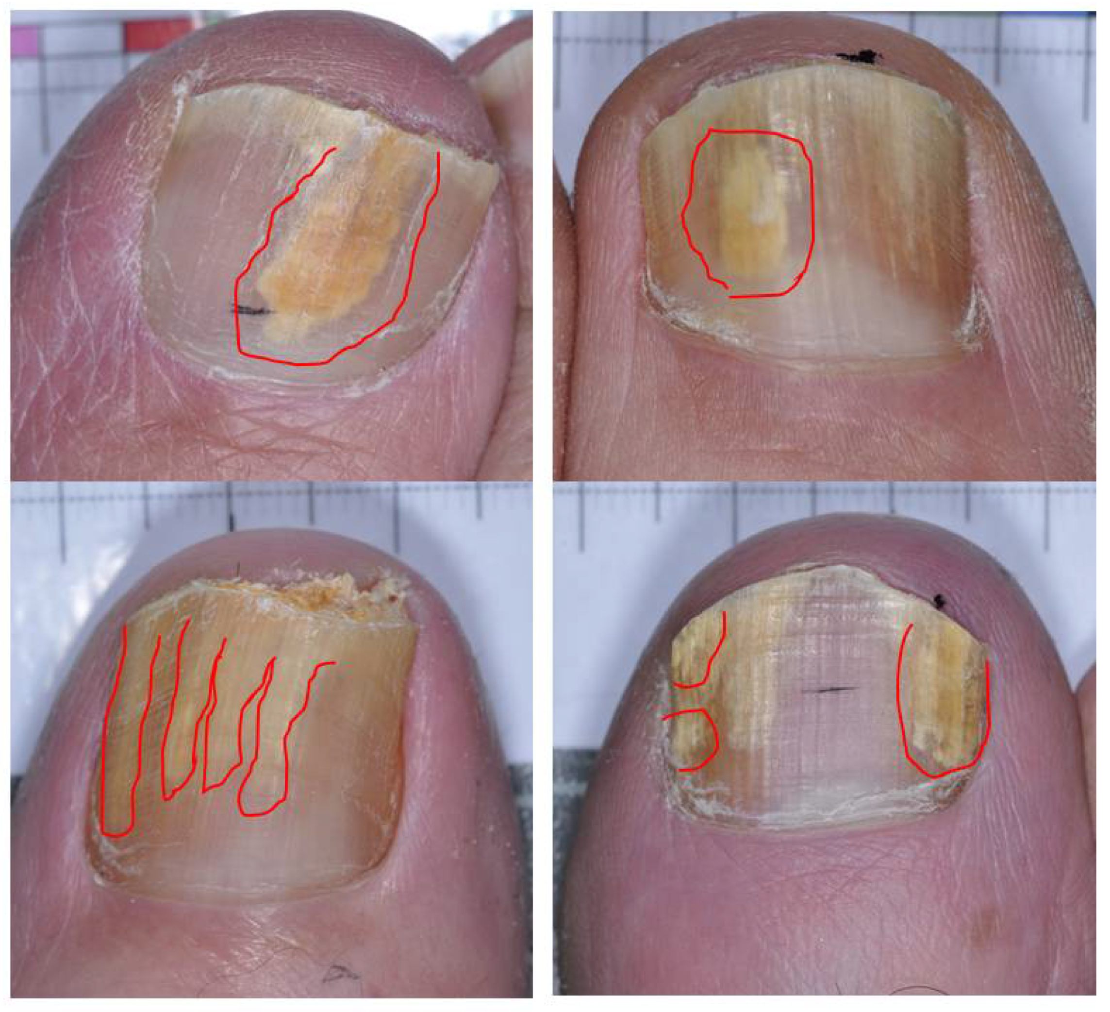 Current treatment of onychomycosis - Indian Journal of Dermatology,  Venereology and Leprology