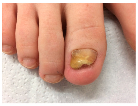 Nail Conditions | Foot Lab Podiatry