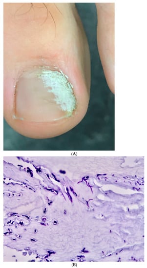 Differential Diagnosis of Nail Psoriasis and Onychomycoses