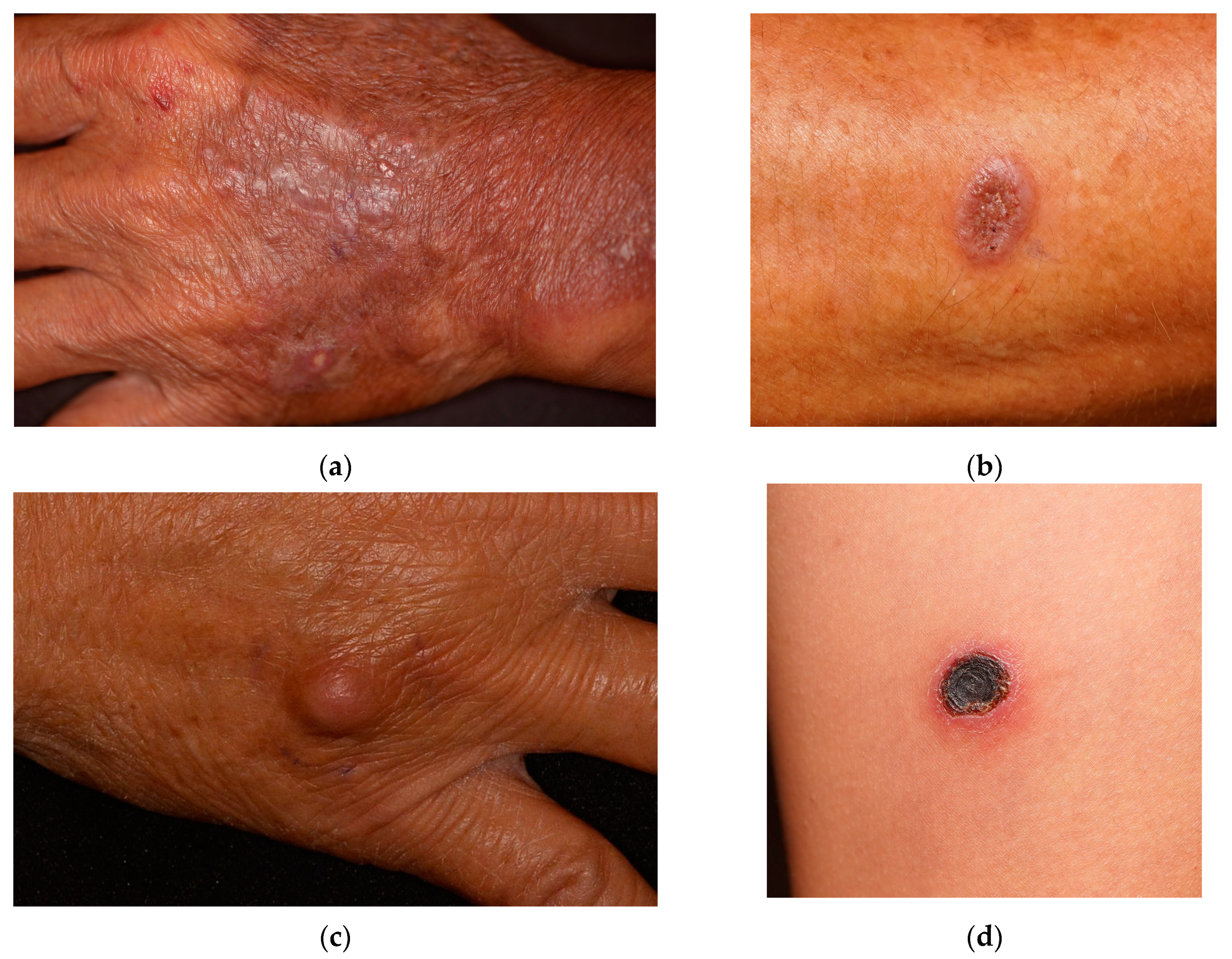 Systemic fungal infection discount