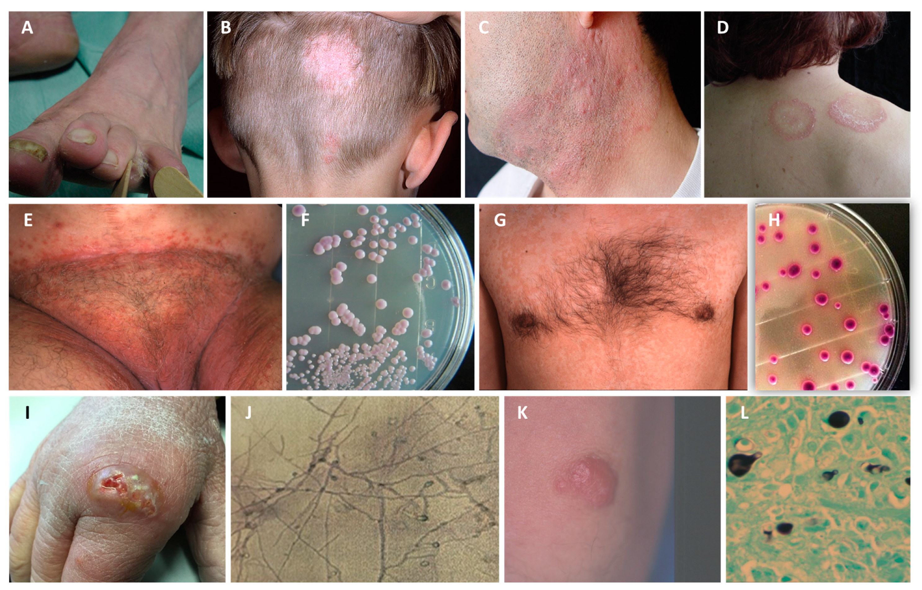 Condition pictured: Tinea Versicolor ⁣⁣⁣ Race: African American ⁣⁣⁣ Notes: Tinea  Versicolor is a fungal infection that causes