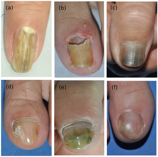 Renew Herbal Anti Fungal Nail Infection| Alibaba.com