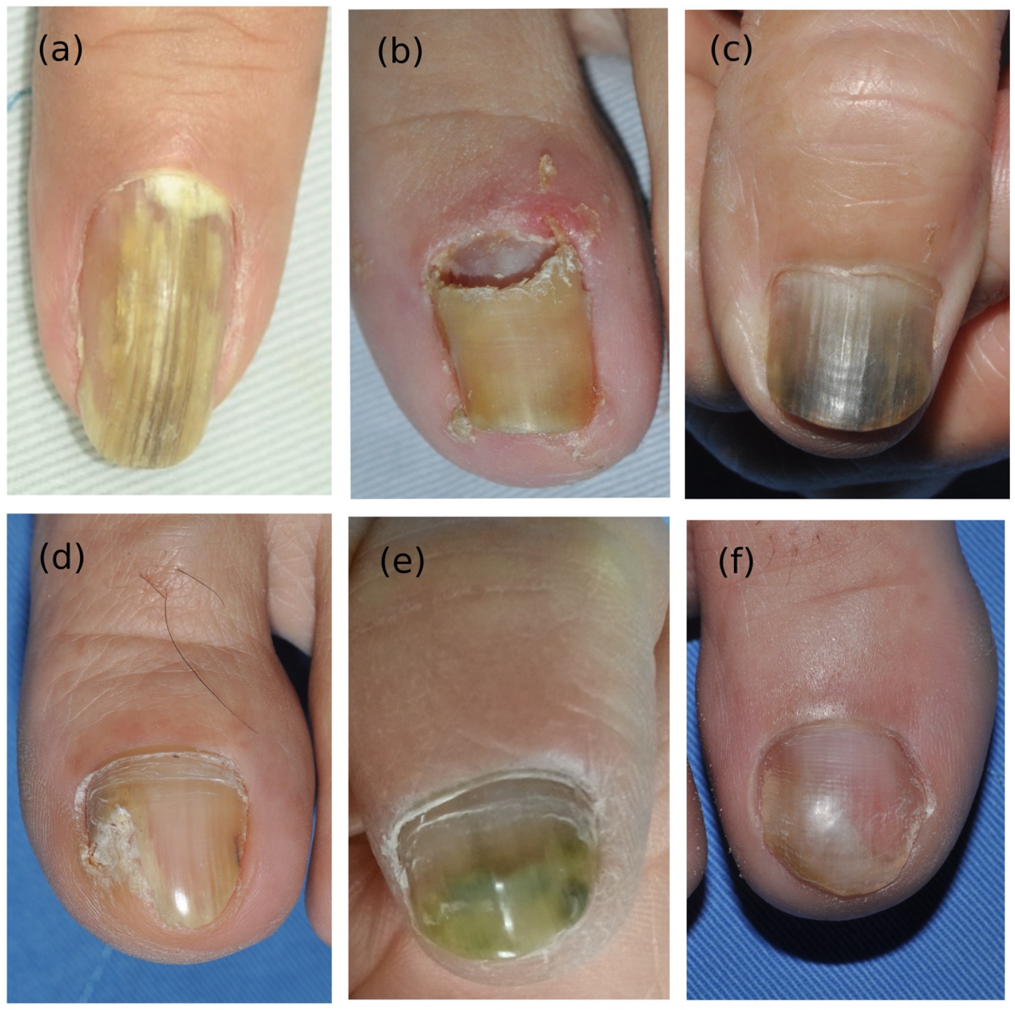 Premium Photo  Fungal nail infection onychomycosis also called