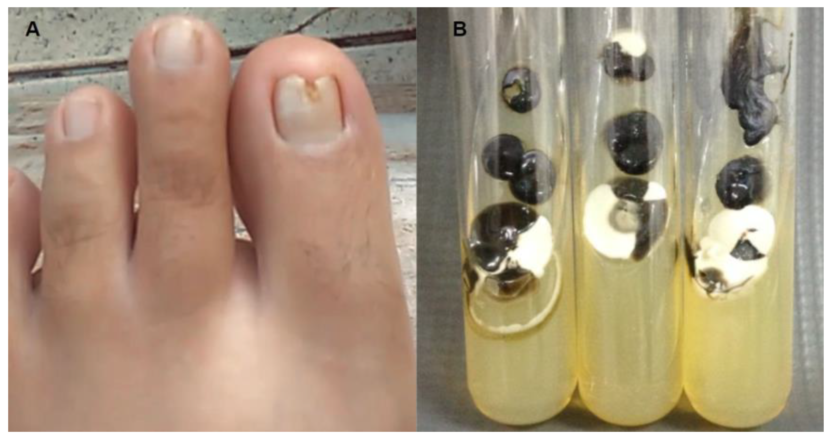 Onychomycosis With Fungal Nail Infection. Onychomycosis And Dry Skin. Candida  Fungus Caused Itching, Cracks, Redness, Exfoliation Of Skin Particles.  Dermatological Problem Фотография, картинки, изображения и сток-фотография  без роялти. Image 204485254