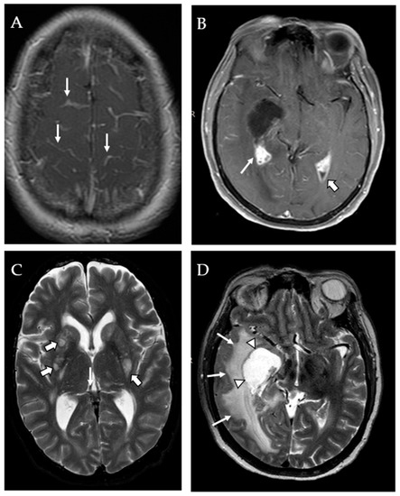 JoF | Free Full-Text | Neuroimaging of Cryptococcal Meningitis in Patients  without Human Immunodeficiency Virus: Data from a Multi-Center Cohort Study
