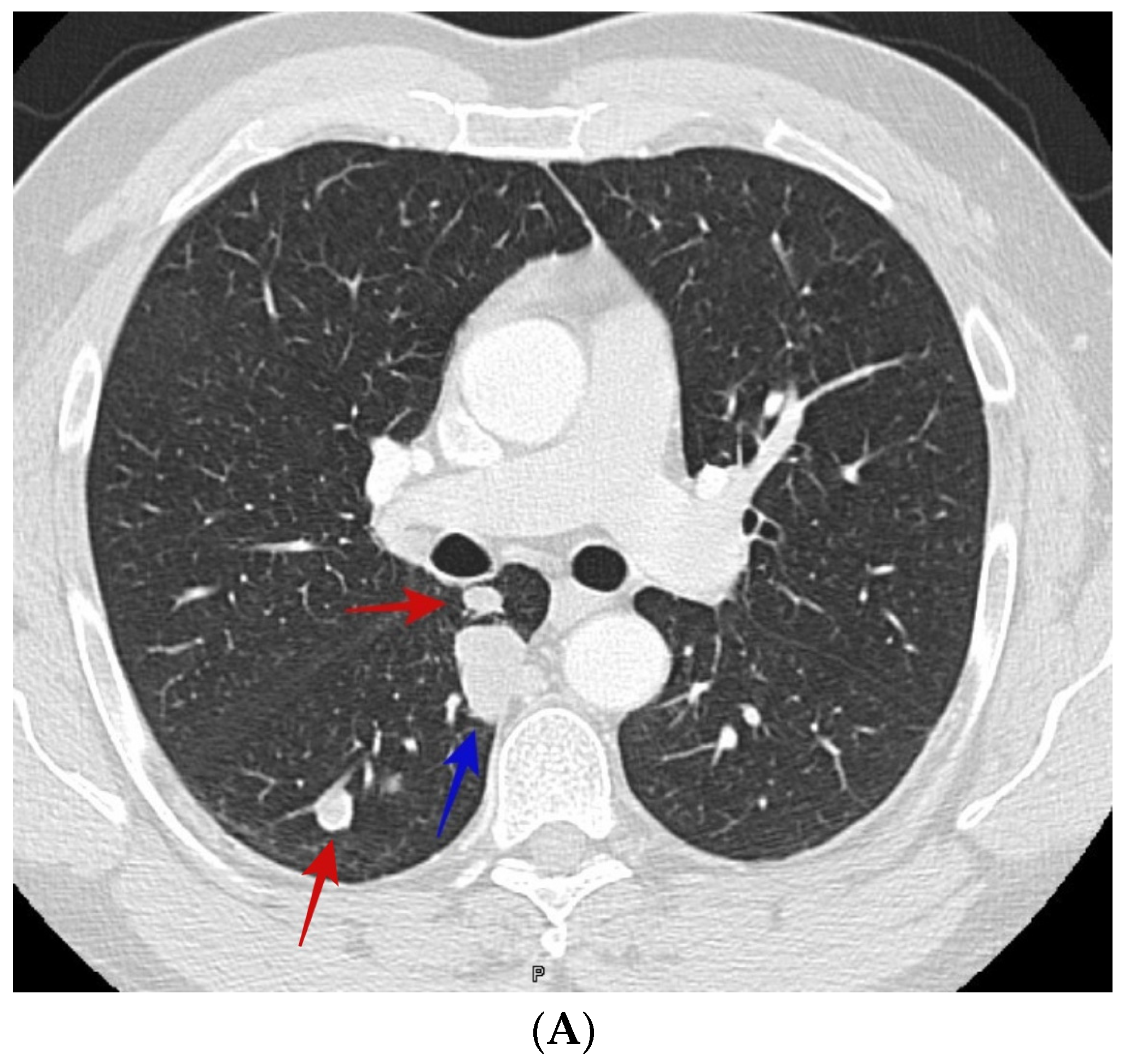 Figure 2 From Classification Of Lung Nodules In Ct Vo - vrogue.co