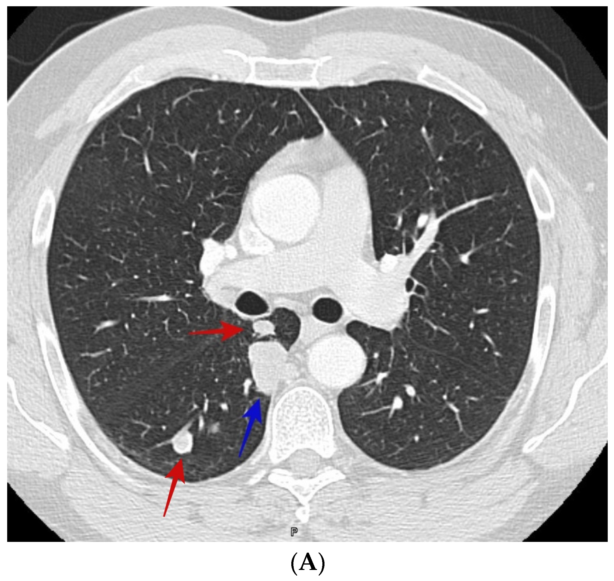5mm Lung Nodule Right