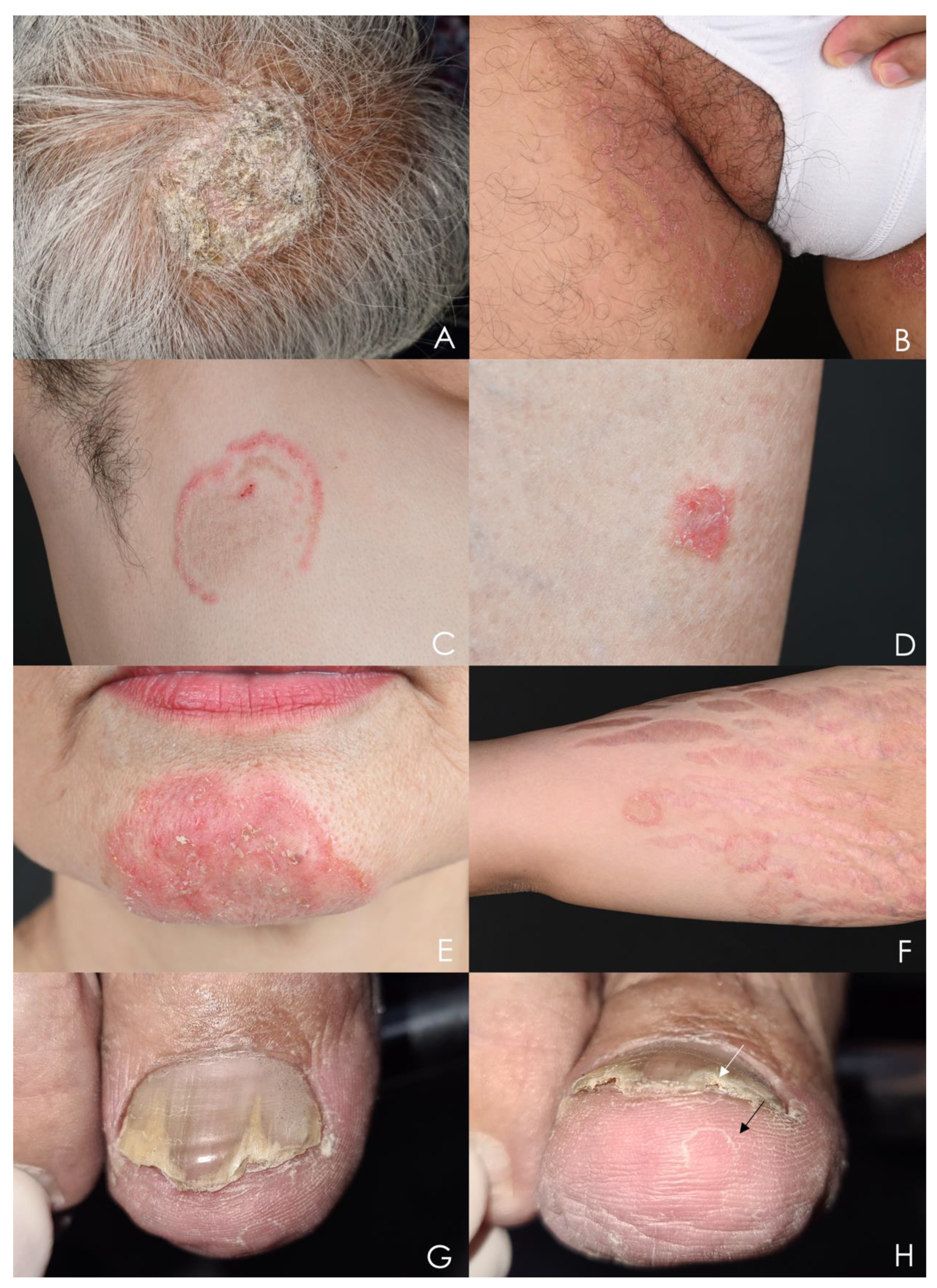 Tinea Barbae Clinical Presentation: History, Physical Examination