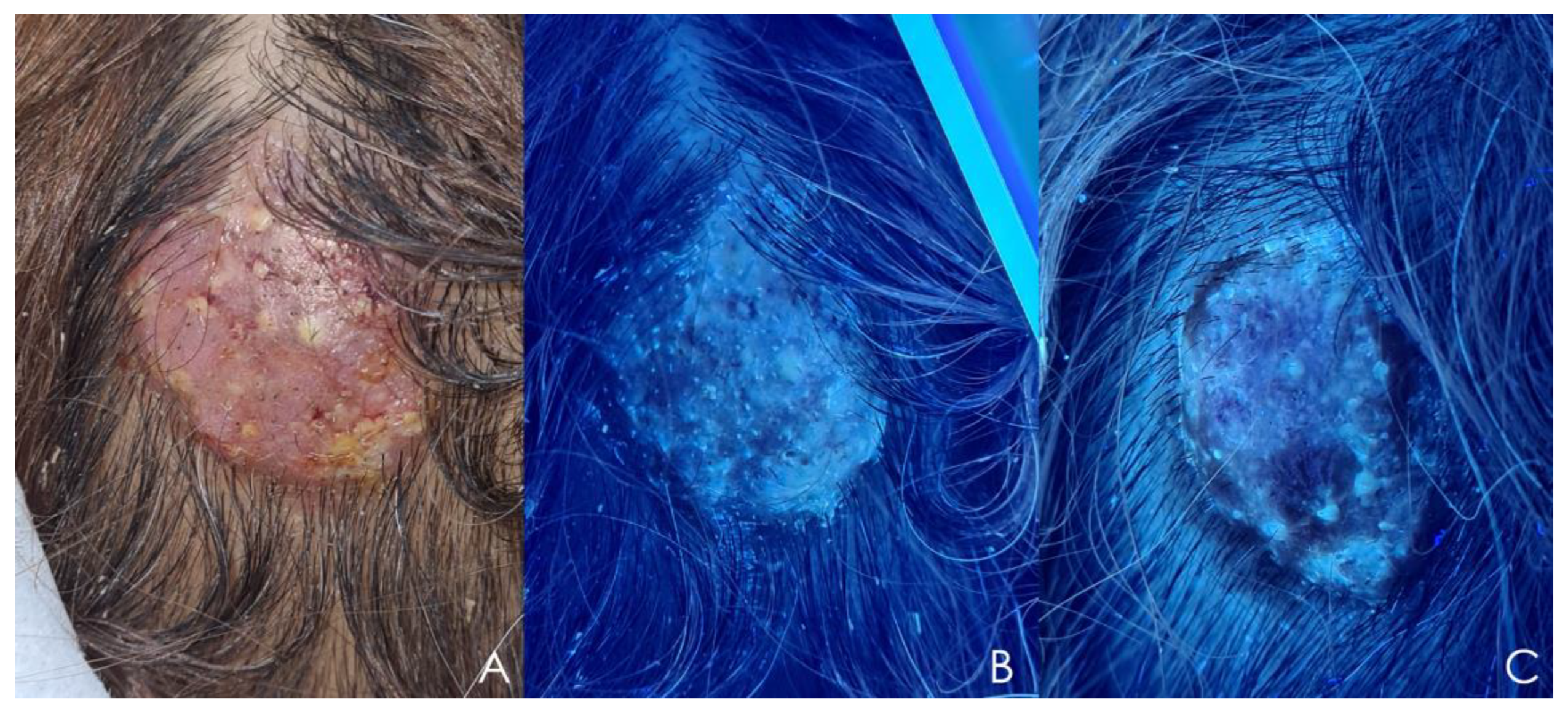 JoF Free Full Text Cutaneous Fungal Infections Caused by
