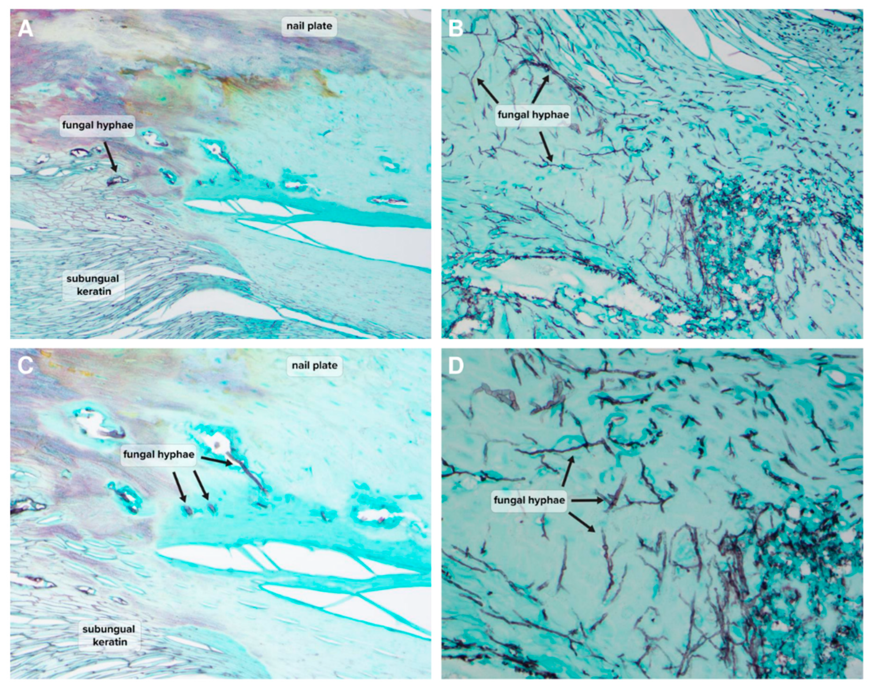 Clinicohistopathologic challenges and traps in the diagnosis of nail unit  melanoma - Jiang - 2023 - Journal of Cutaneous Pathology - Wiley Online  Library