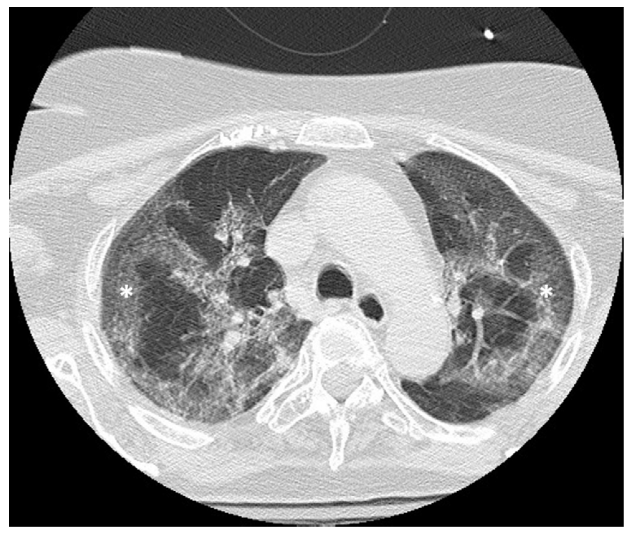 Jpm Free Full Text Spontaneous Rectal Perforation In A Patient With Sars Cov 2 Infection Html Jpm Free Full Text Spontaneous Rectal Perforation In A Patient With Sars Cov 2 Infection Html