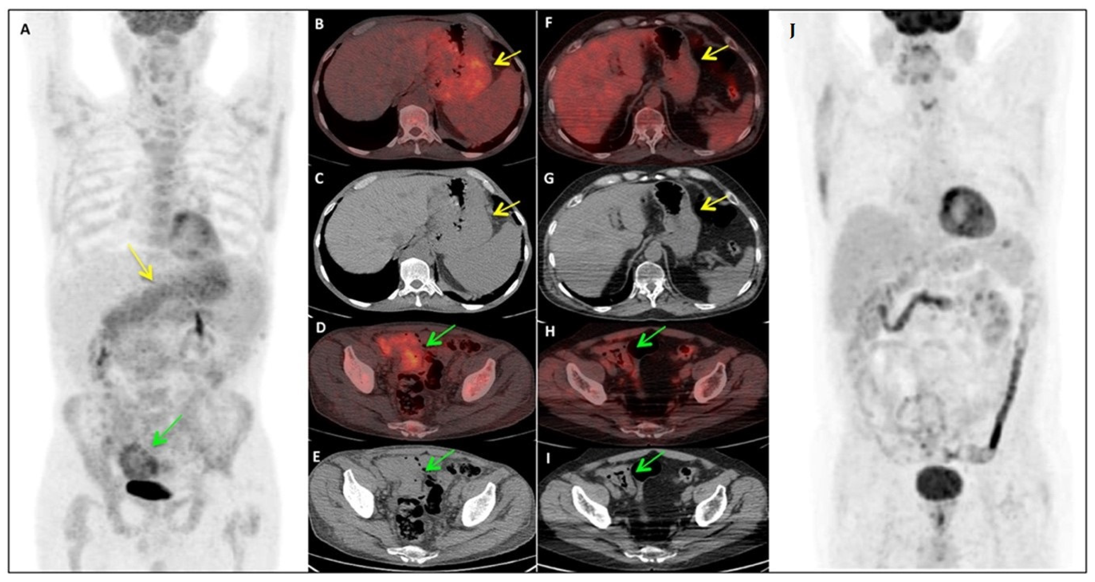 what is benign asbestos pleural effusion