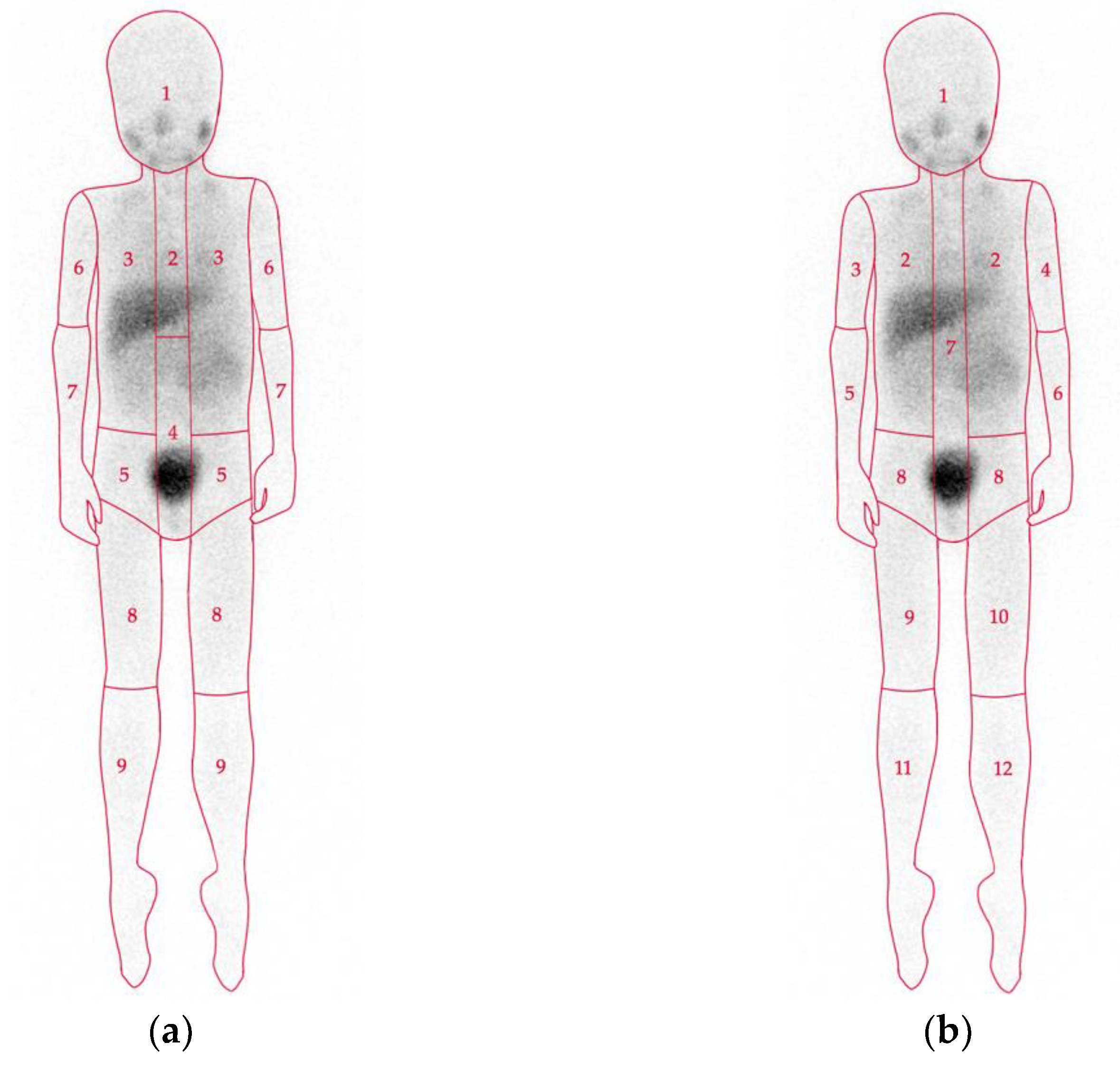 Nuclear Medicine Imaging in Neuroblastoma: Current Status and New  Developments