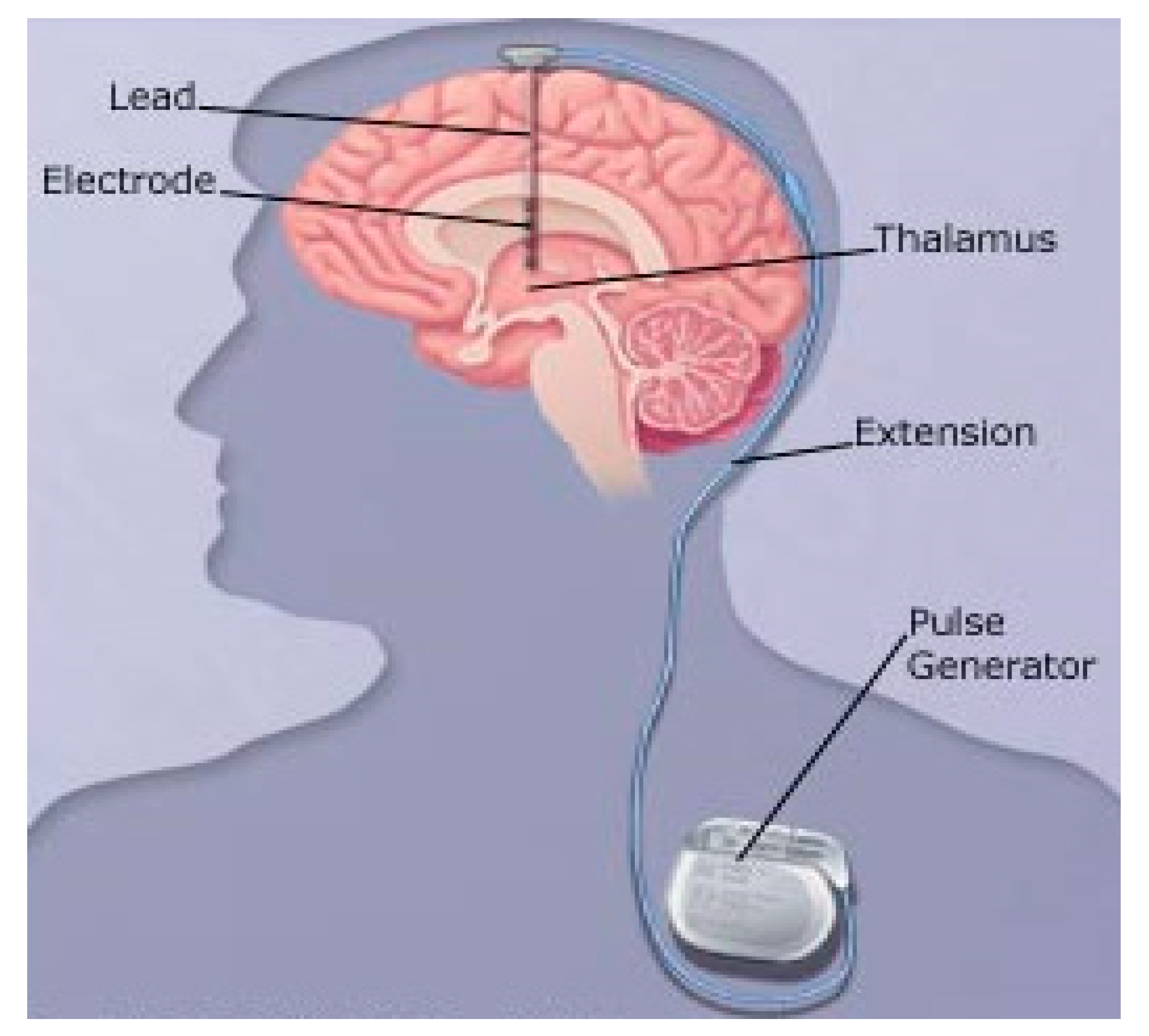 Deep brain. Глубокая стимуляция мозга при болезни Паркинсона. Электроды в головной мозг. Имплантация электродов в мозг. Нейростимулятор головного мозга.