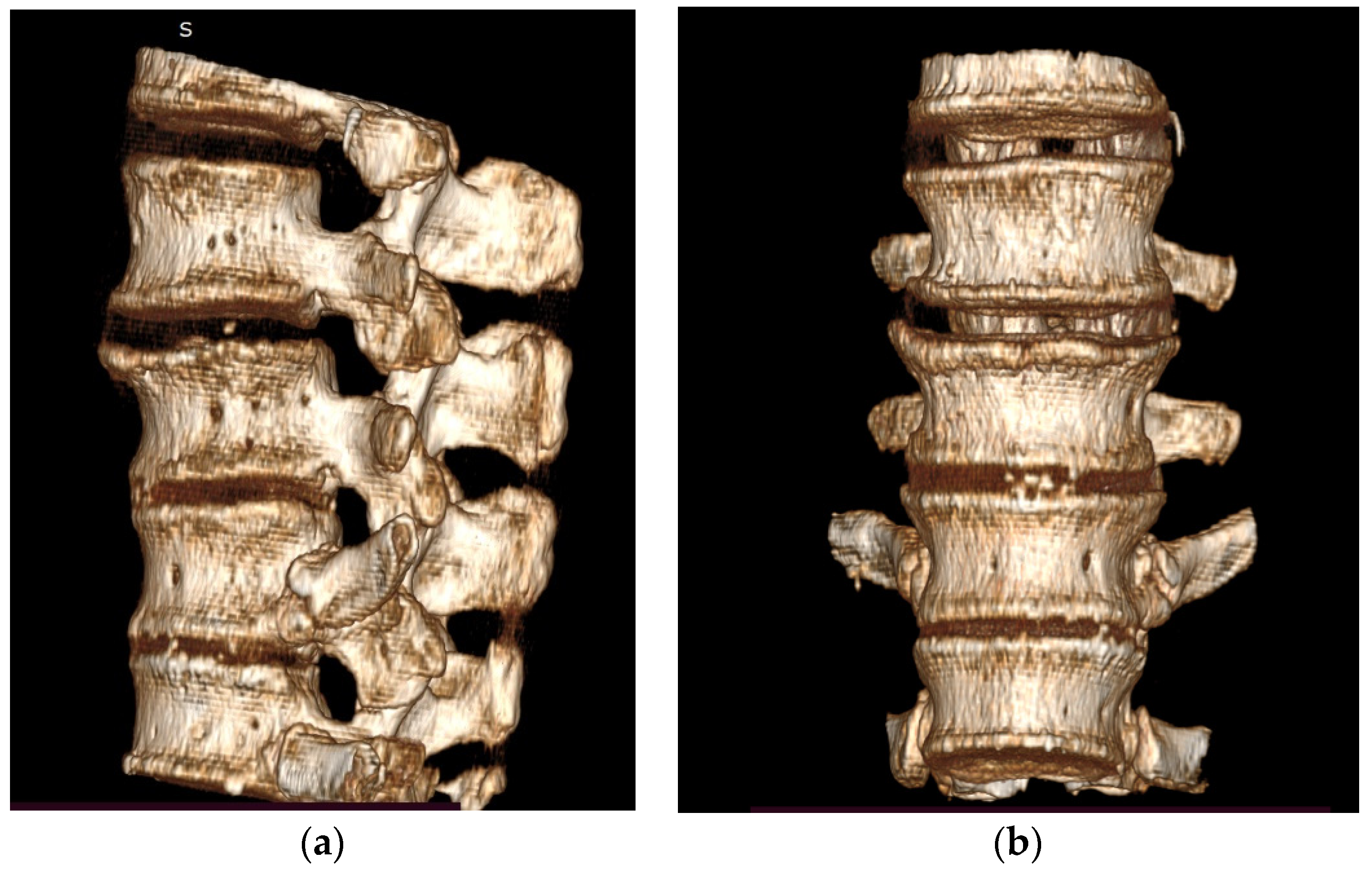 Biomechanical Study of the Osteoporotic Spine Fracture