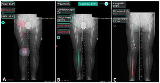 Patient-Specific Instrument Guided Double Chevron-Cut Distal