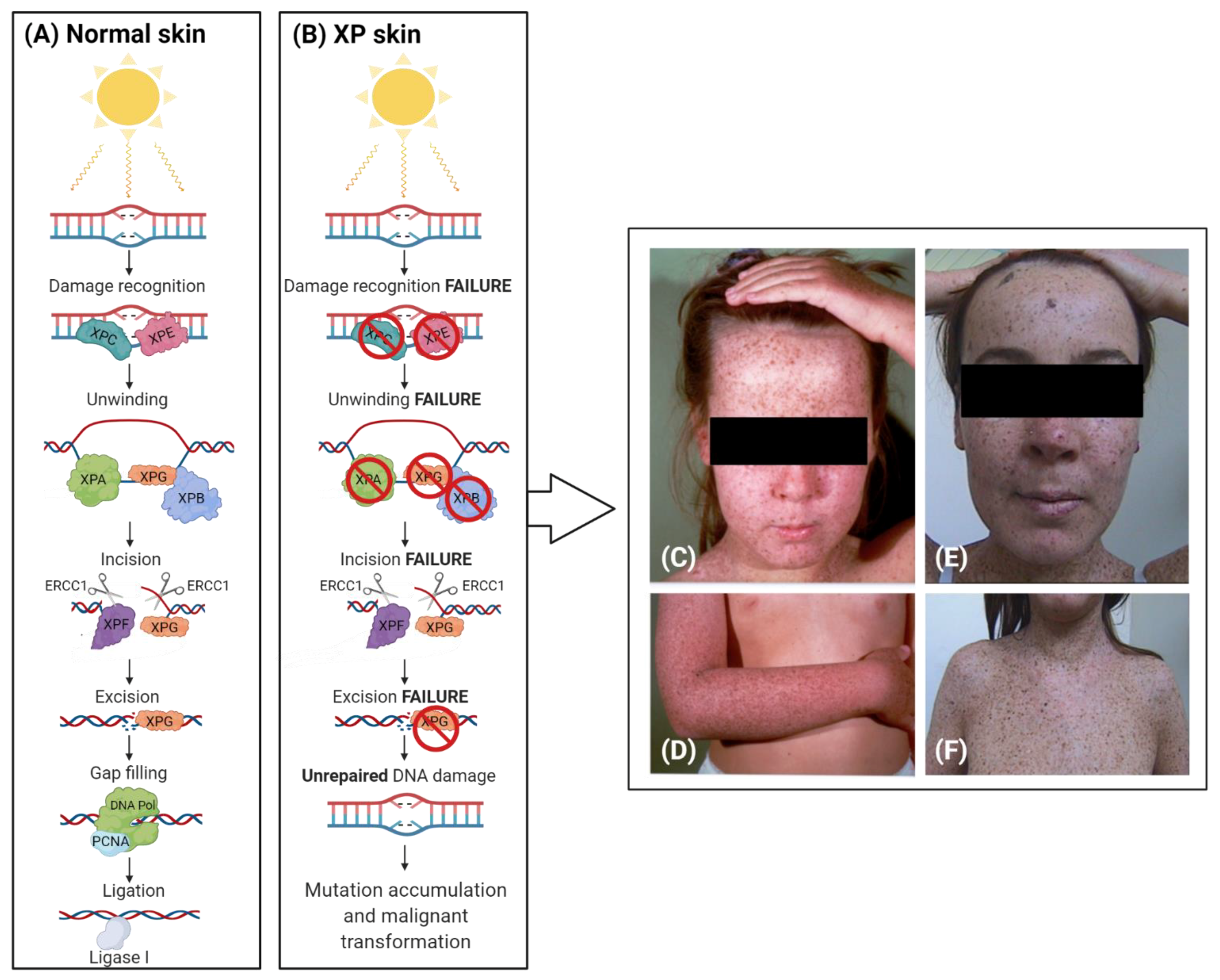 Cockayne Syndrome: Most Up-to-Date Encyclopedia, News & Reviews