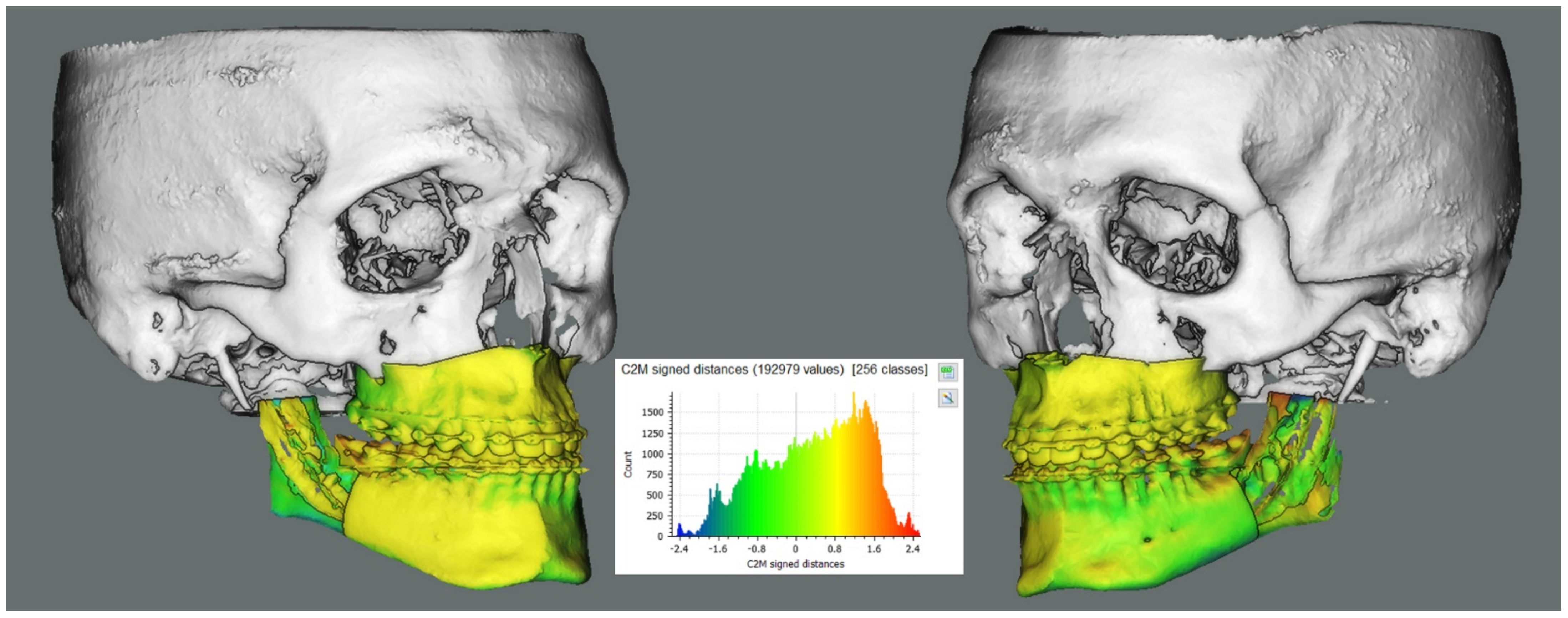 PSI-Guided Mandible-First Orthognathic Surgery: Maxillo
