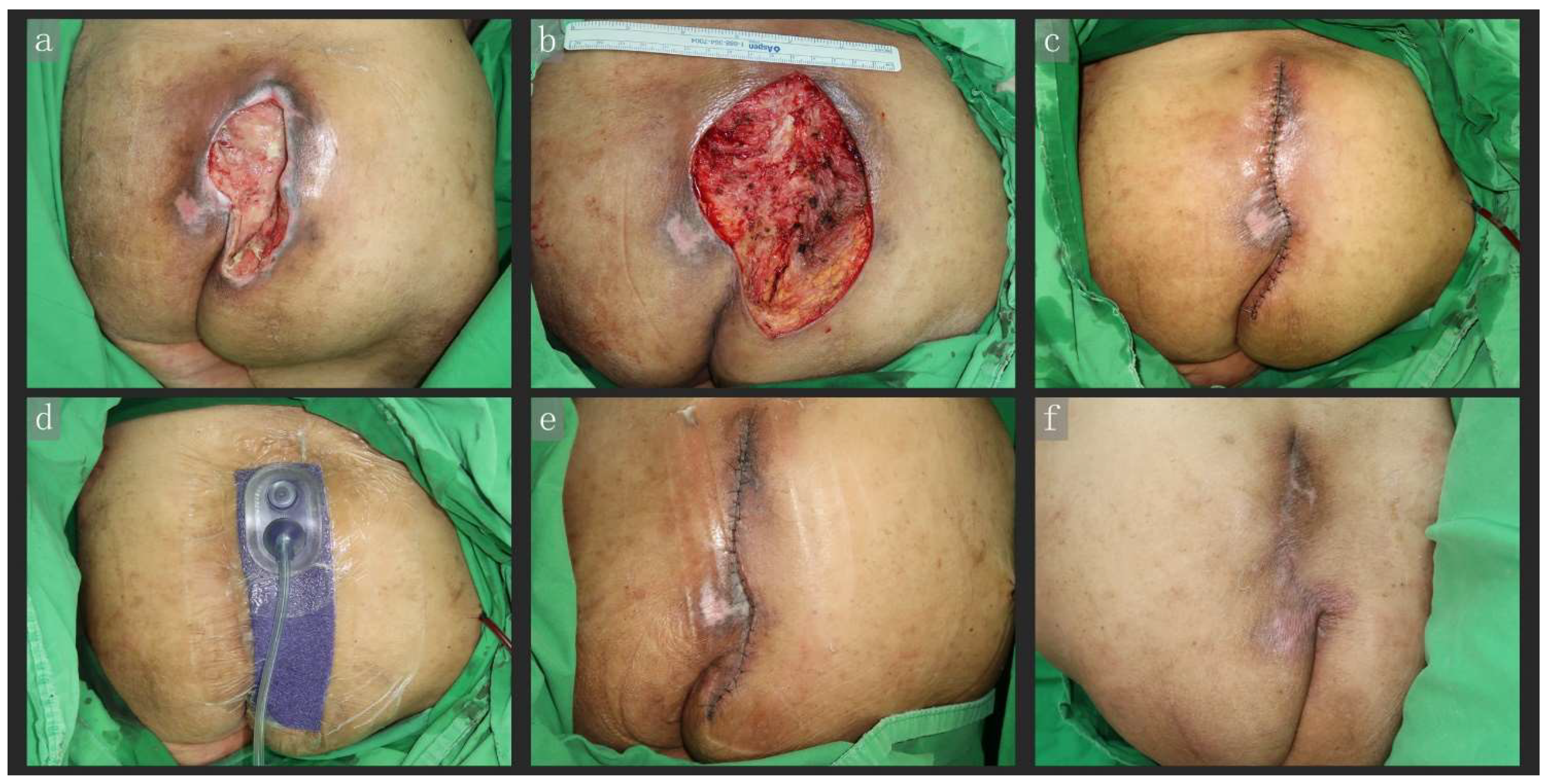 Skin & Pressure Sores after Spinal Cord Injury