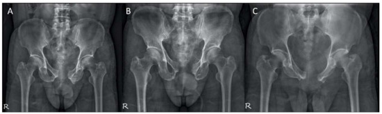 Does 3D Printing-Assisted Acetabular or Pelvic Fracture Surgery