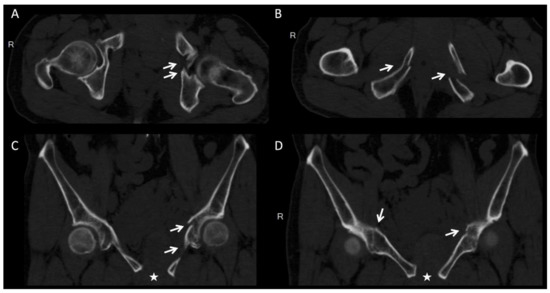 Does 3D Printing-Assisted Acetabular or Pelvic Fracture Surgery