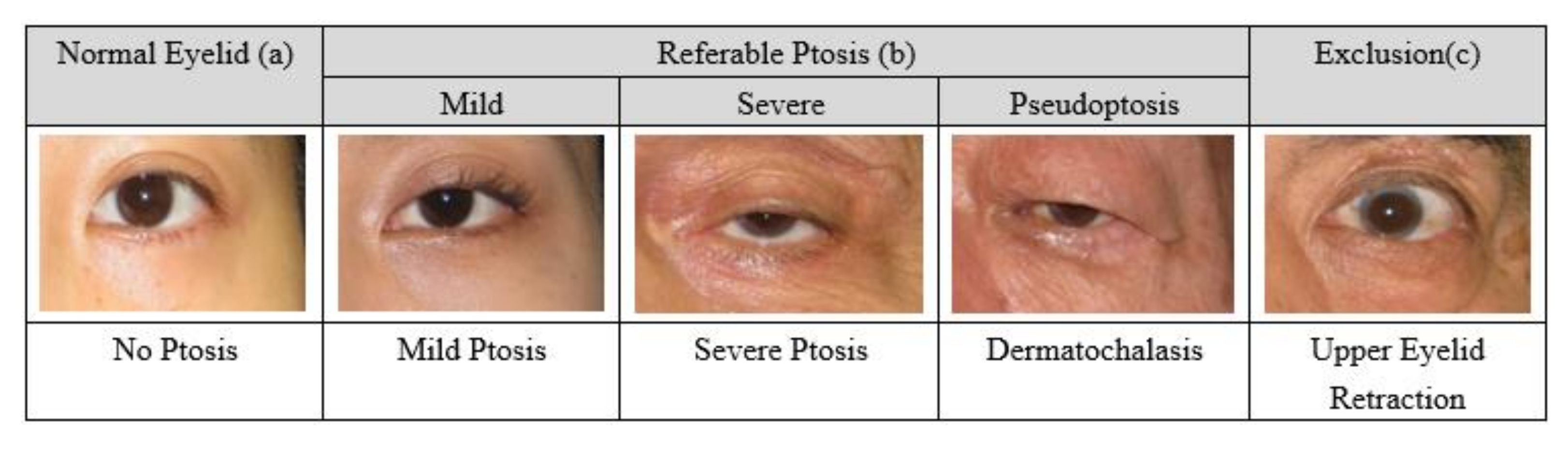 Regnault ptosis classification; (A) normal, (B) type 1: mild