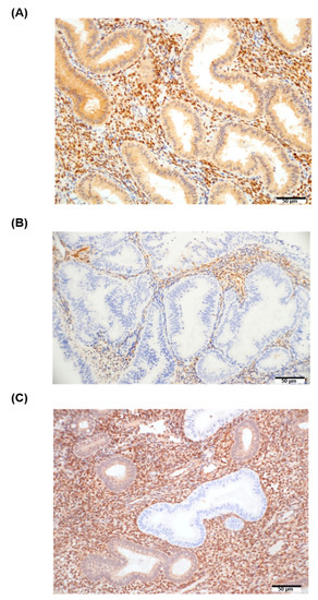 MicroRNAs as Predictors of Future Uterine Malignancy in Endometrial ...
