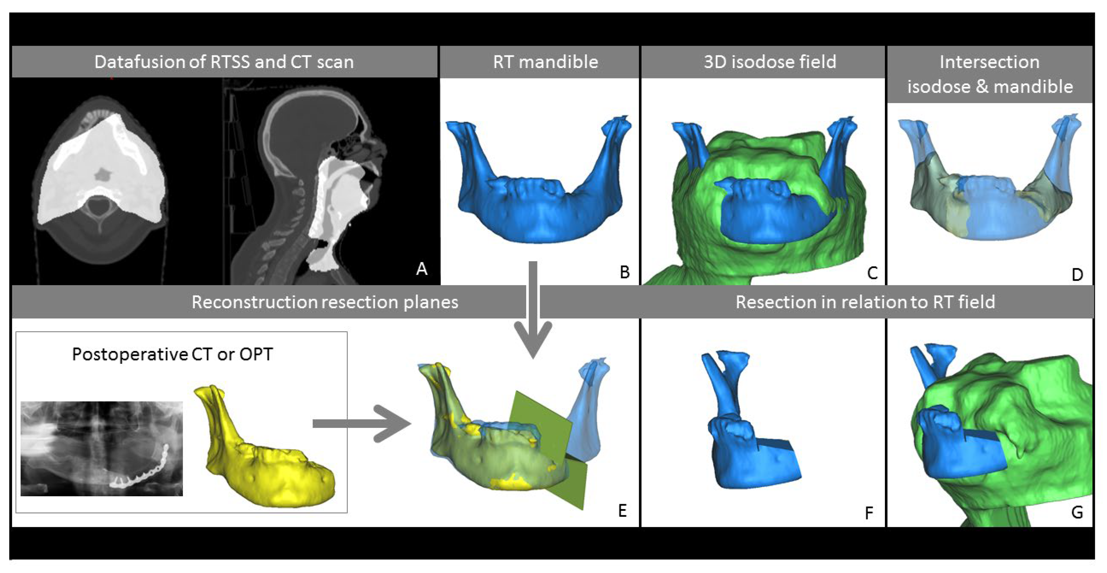 Three-Dimensional Evaluation of Isodose Radiation Volumes in Cases 