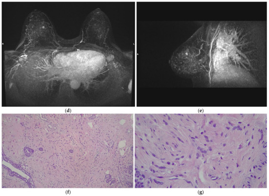 Diagnostic Challenge of Invasive Lobular Carcinoma of the Breast: What ...