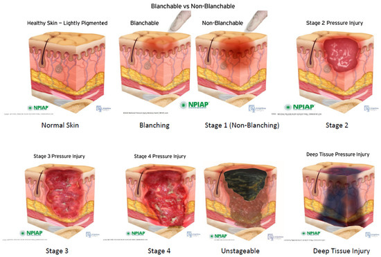 Pressure Ulcer Cushion SUAPEL. anitized® Treatment - Ortohispania