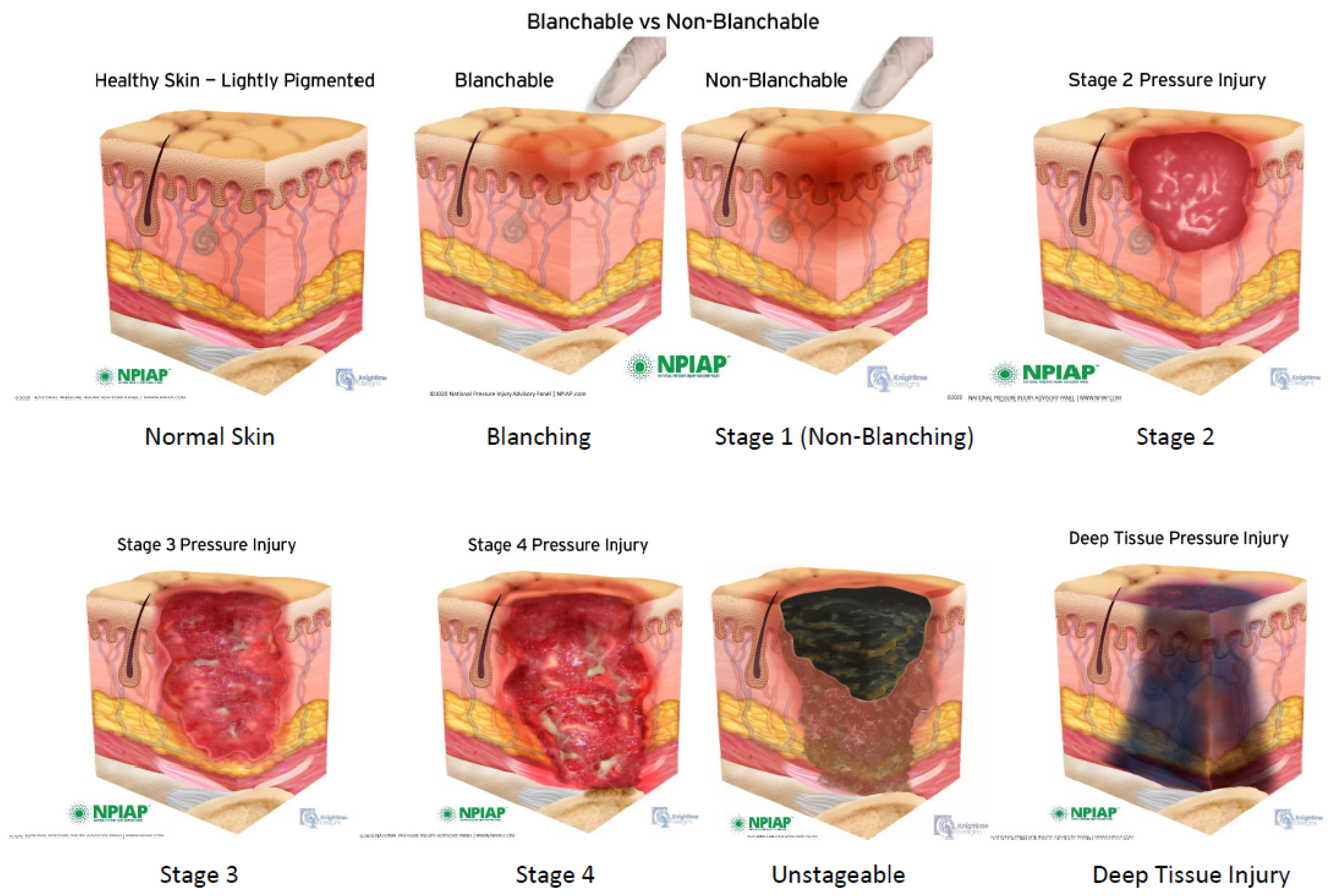 A Review of Deep Tissue Injury Development, Detection, and Prevention:  Shear Savvy