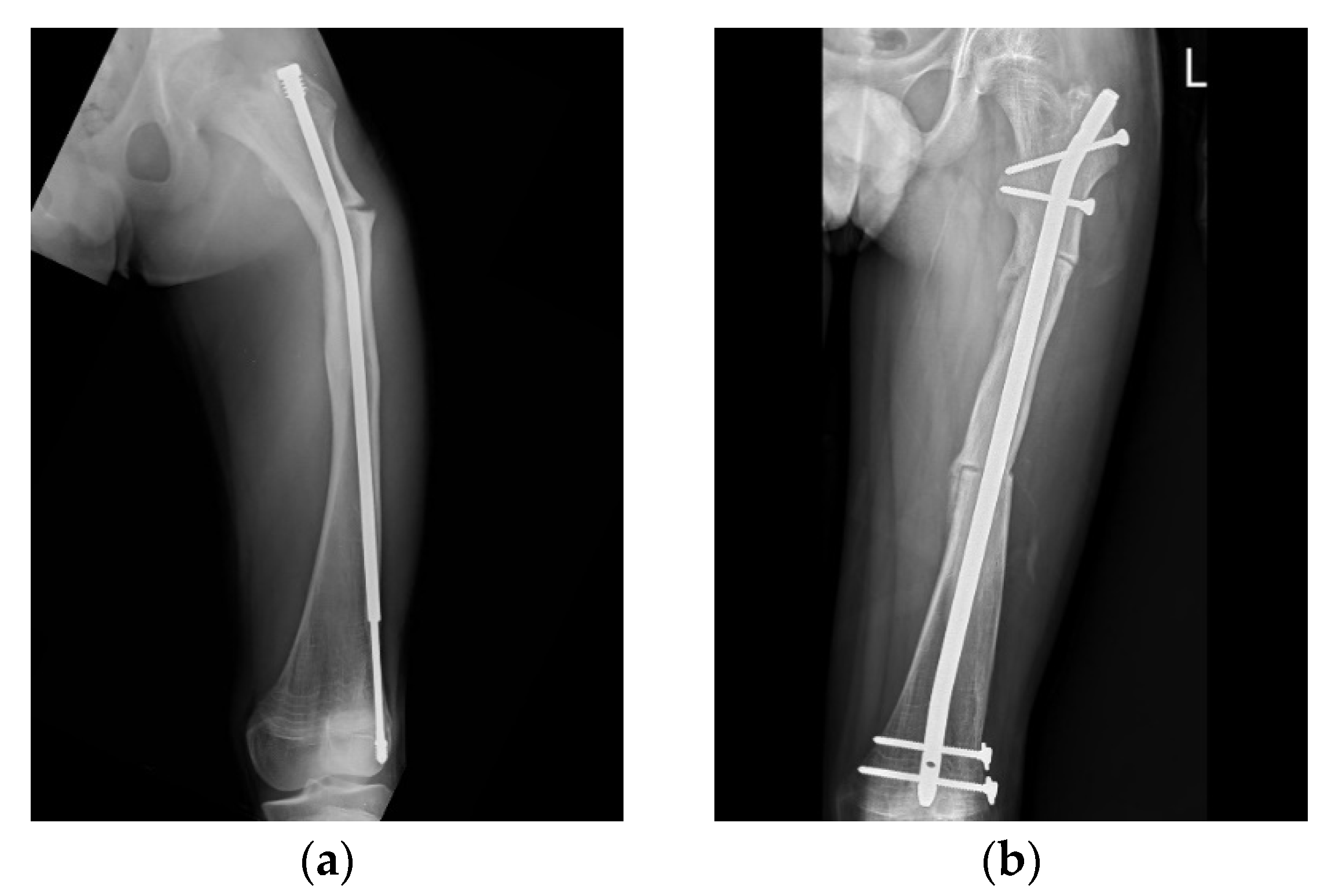 Defining Length Stability in Paediatric Femoral Shaft Fractures Treated  with Titanium Elastic Nails - Alvin K. Shieh, Augustine M. Saiz, Kelsey S.  Hideshima, Brian M. Haus, Holly B. Leshikar, 2021