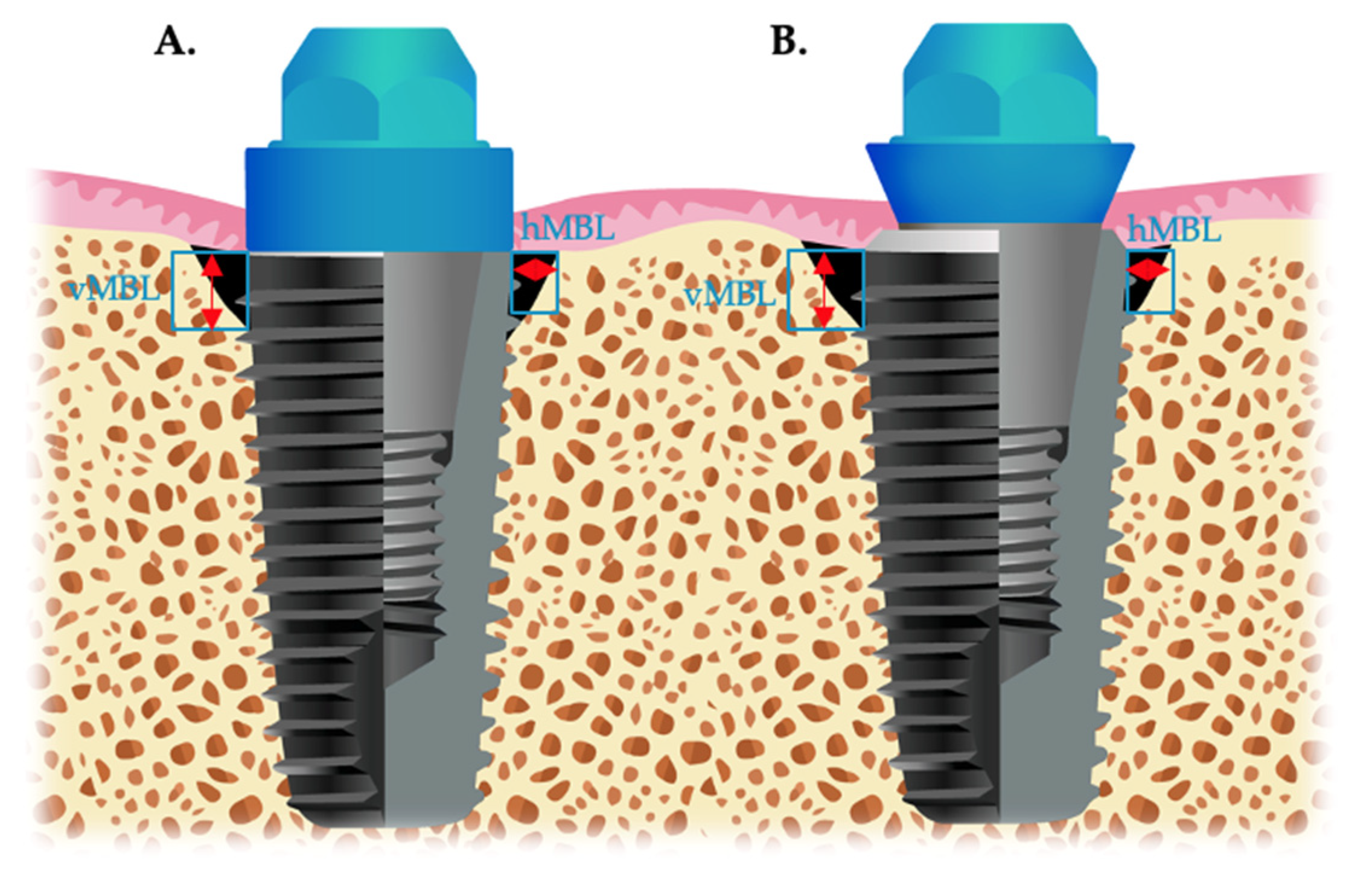 JPM Free FullText PeriImplant Marginal Bone Changes around Dental
