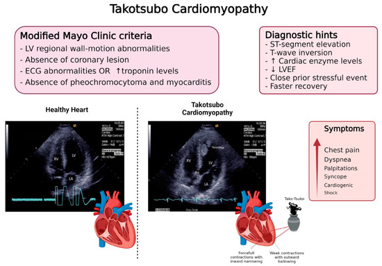 The Octopus Trap of Takotsubo and Stroke Genetics Biomarkers and Clinical Management