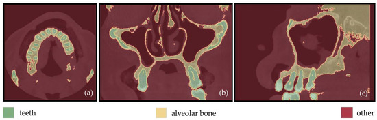 Evaluation of 3D Modeling Workflows Using Dental CBCT Data for ...