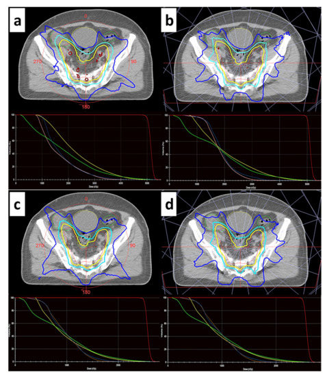 Assessment of Radiation-Induced Bladder and Bowel Cancer Risks after ...