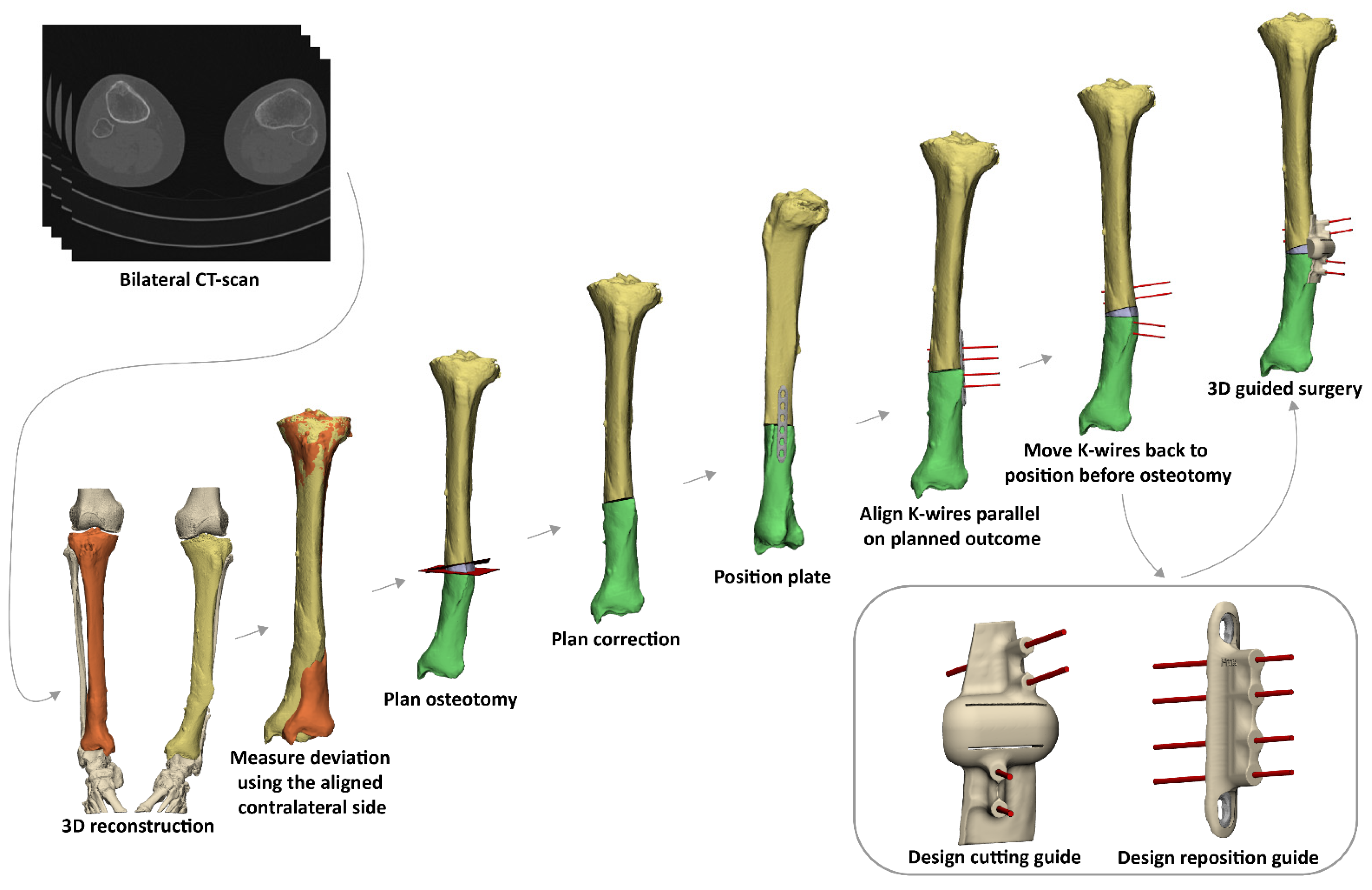 A Two-Step Approach for 3D-Guided Patient-Specific A Two-Step Approach for 3D-Guided Patient-Specific