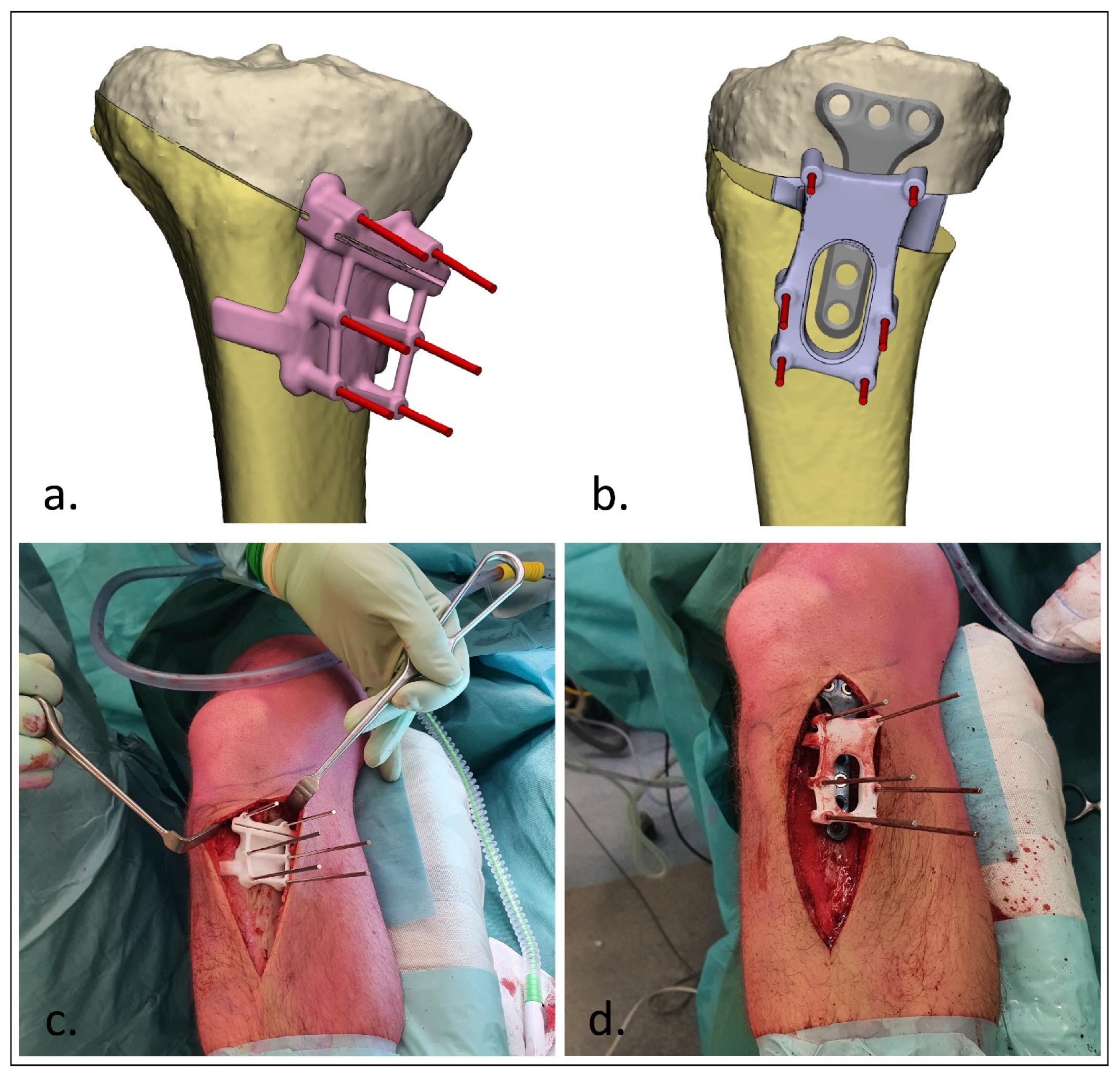 A Two-Step Approach for 3D-Guided Patient-Specific A Two-Step Approach for 3D-Guided Patient-Specific