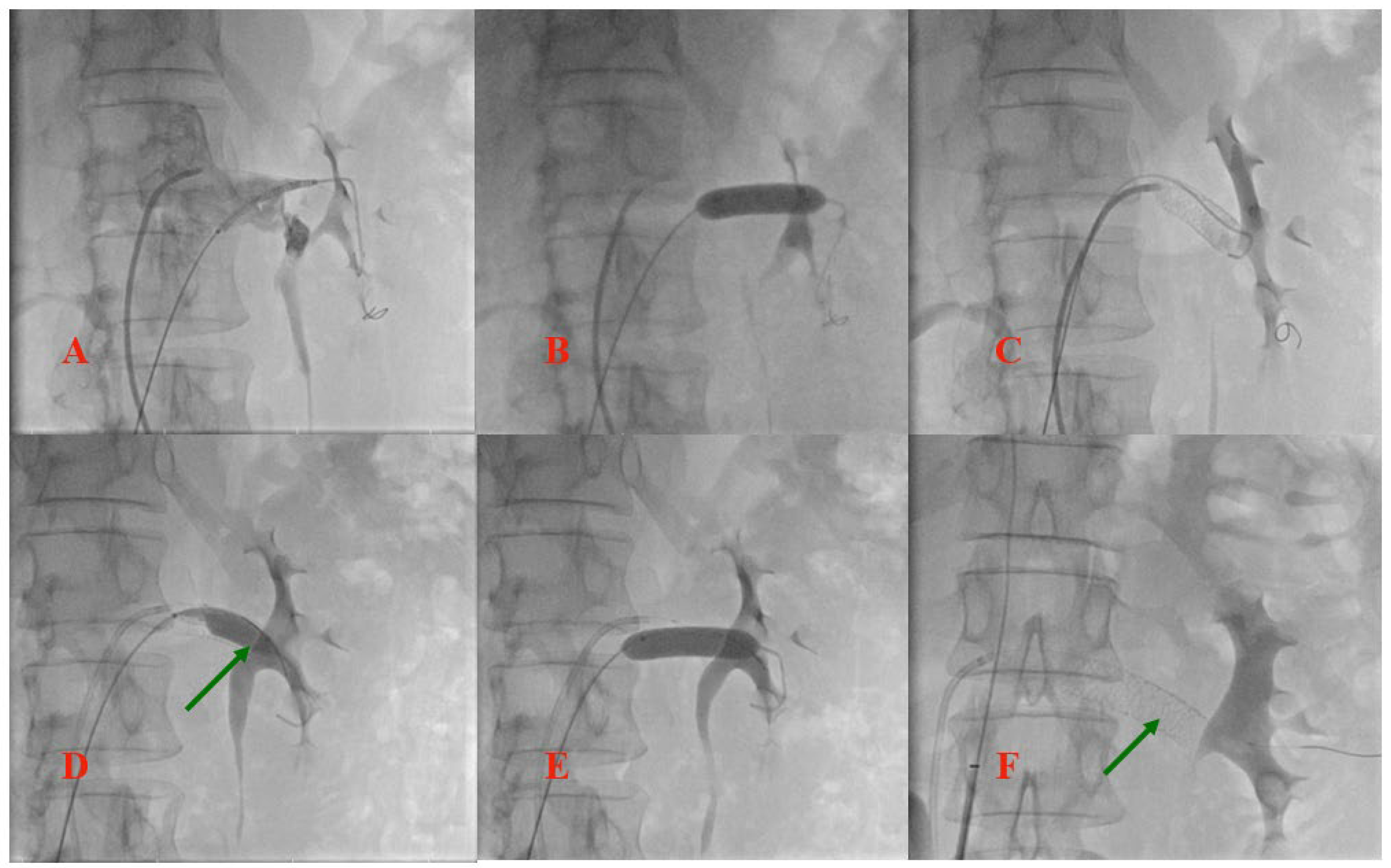 JPM Free FullText Interventional Management of a Rare Combination