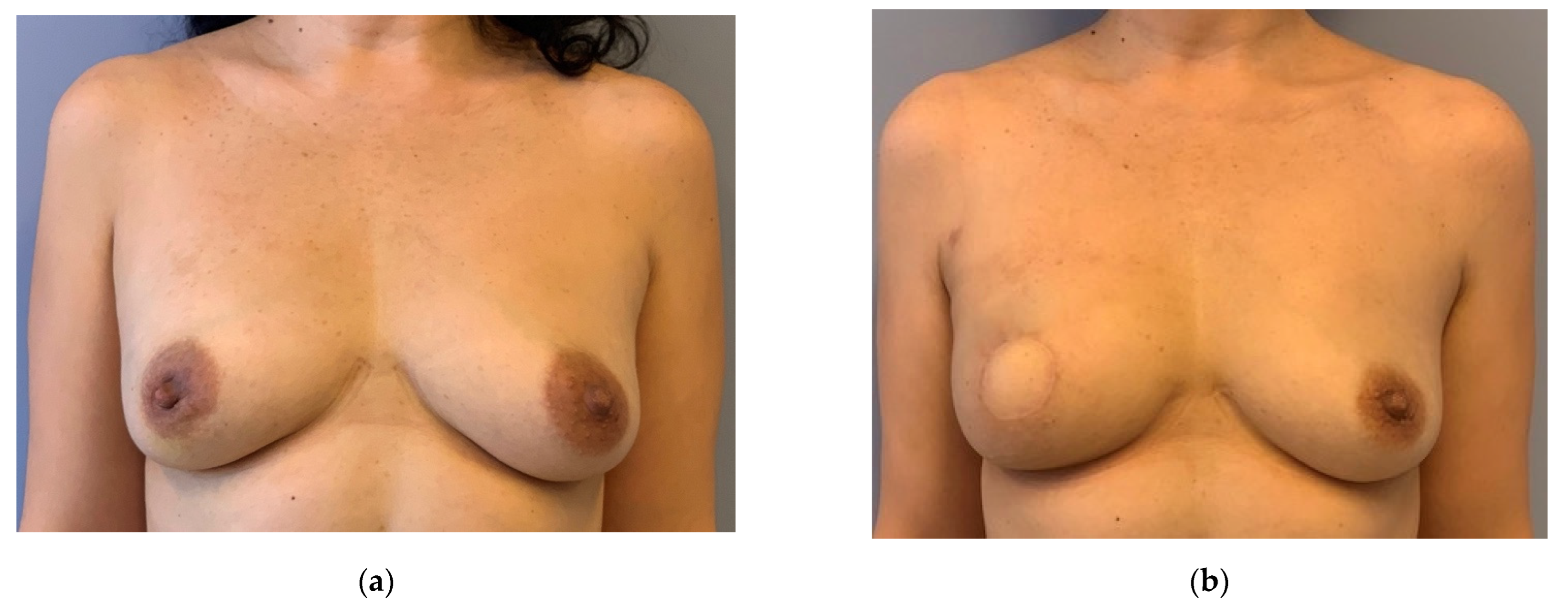 JPM Free Full-Text Autologous Breast Reconstruction with Free Nippleandndash;Areola Graft after Circumareolar (Skin Reducing) Mastectomy
