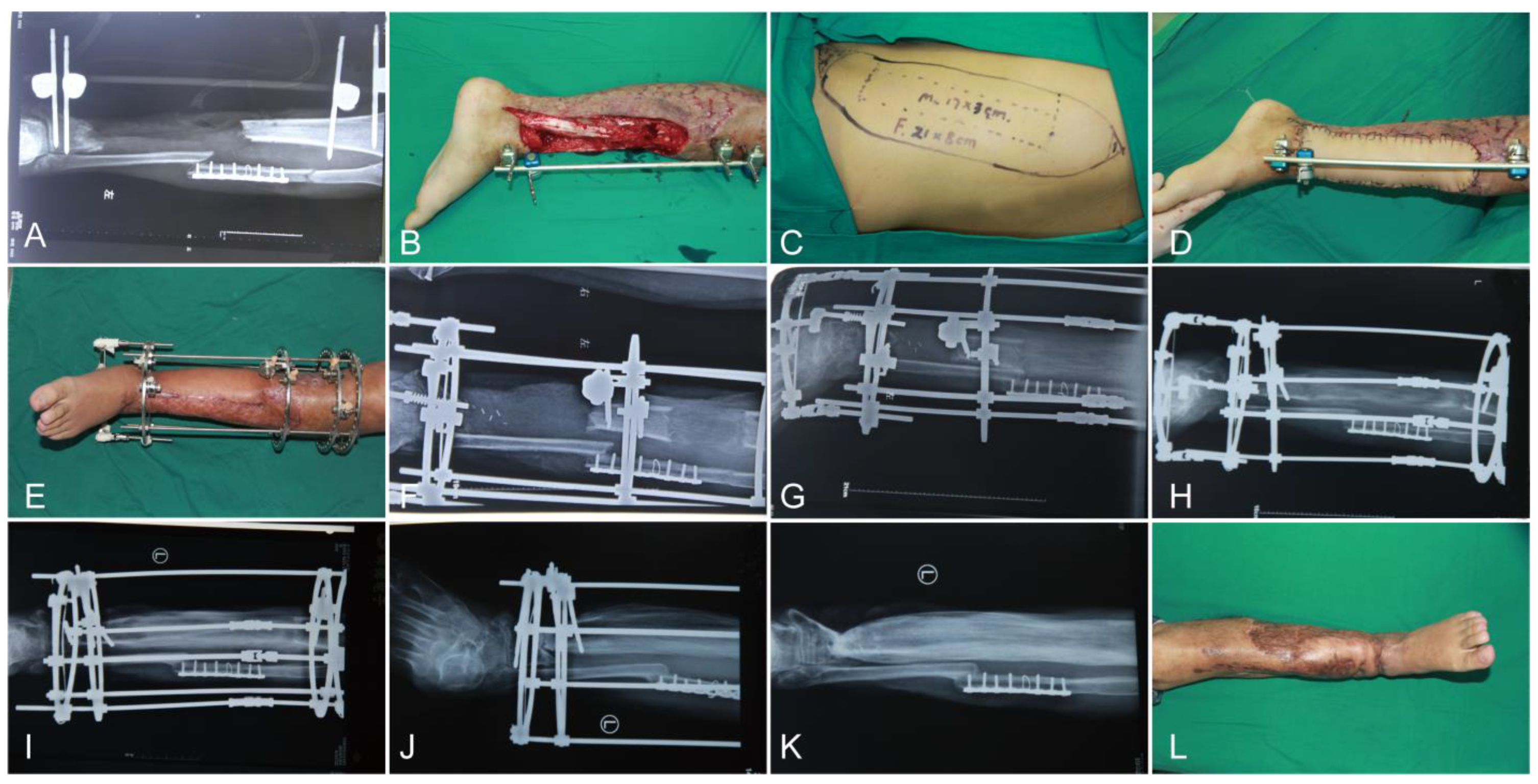 Llizarov Tibia Ring External Fixator Lengthening for Delayed